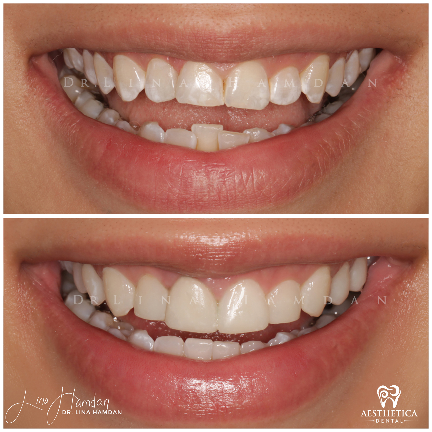 Dental Composite Bonding case 1 done by Dr. Lina Hamdan. - Before and After Images - 4