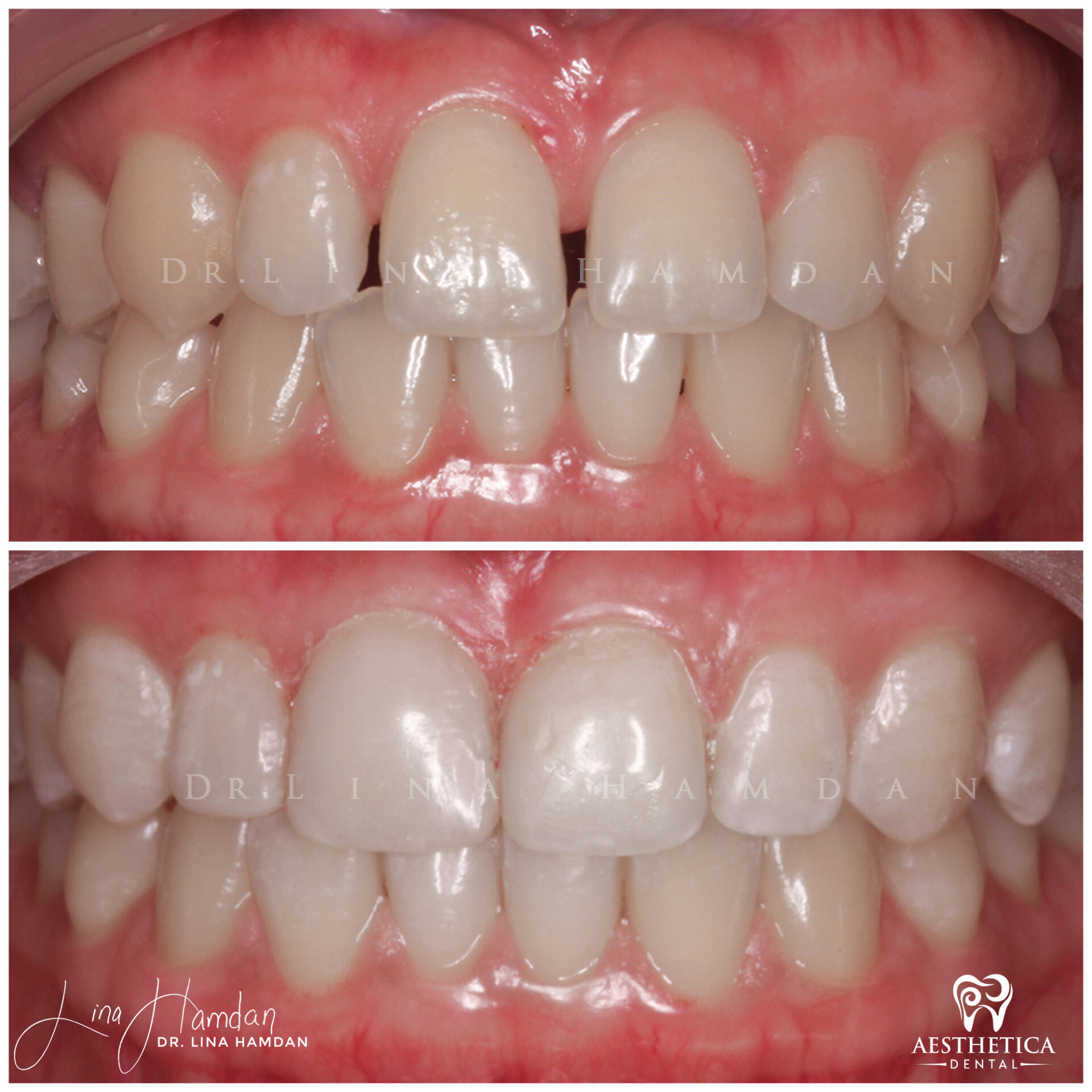 Dental Composite Bonding case 3 done by Dr. Lina Hamdan. - Before and After Images - 3