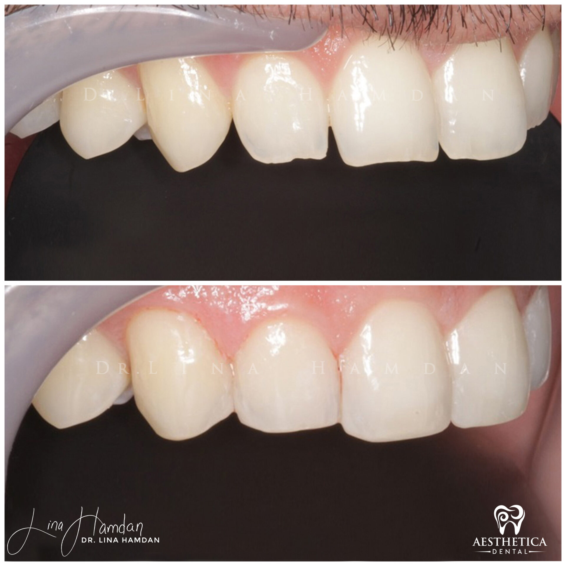 Dental Composite Bonding case 5 done by Dr. Lina Hamdan. - Before and After Images - 4