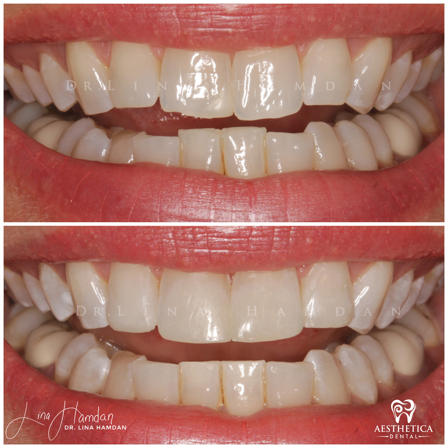 Dental Composite Bonding case 7 done by Dr. Lina Hamdan. - Before and After Images - 2