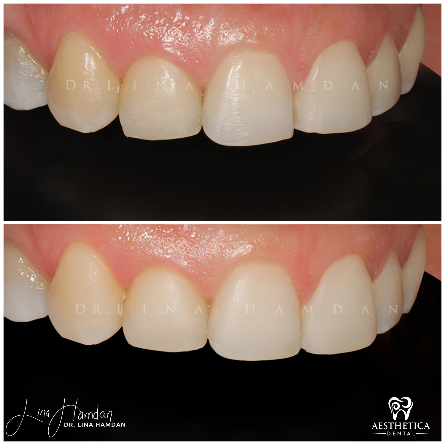 Dental Composite Bonding case 15 done by Dr. Lina Hamdan. - Before and After Images - 4