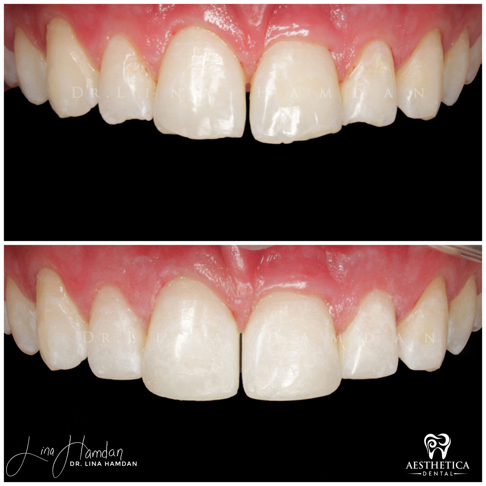 Dental Composite Bonding case 17 done by Dr. Lina Hamdan. - Before and After Images - 3