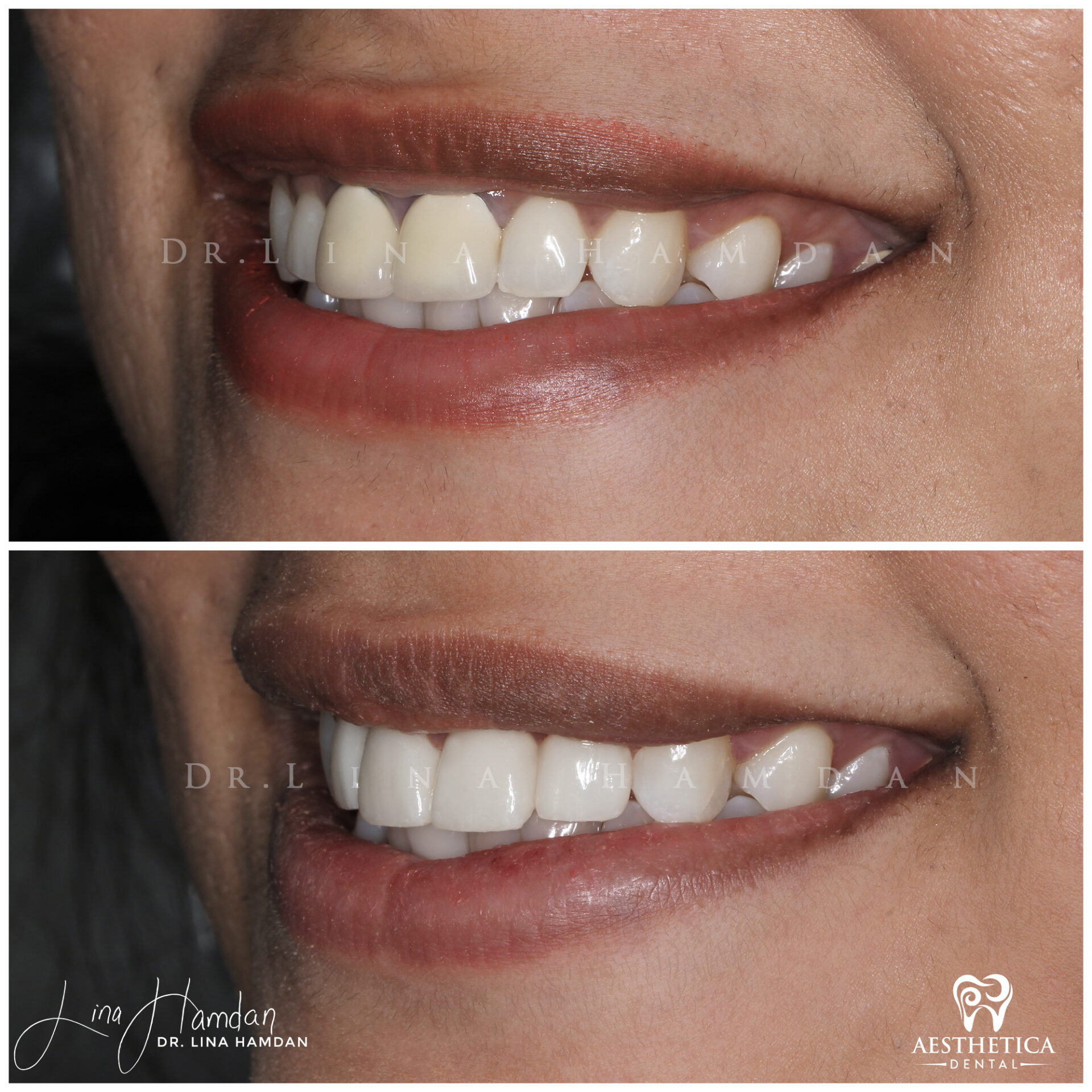 Porcelain Veneers case 8 done by Dr. Lina Hamdan. - Before and After Images - 3