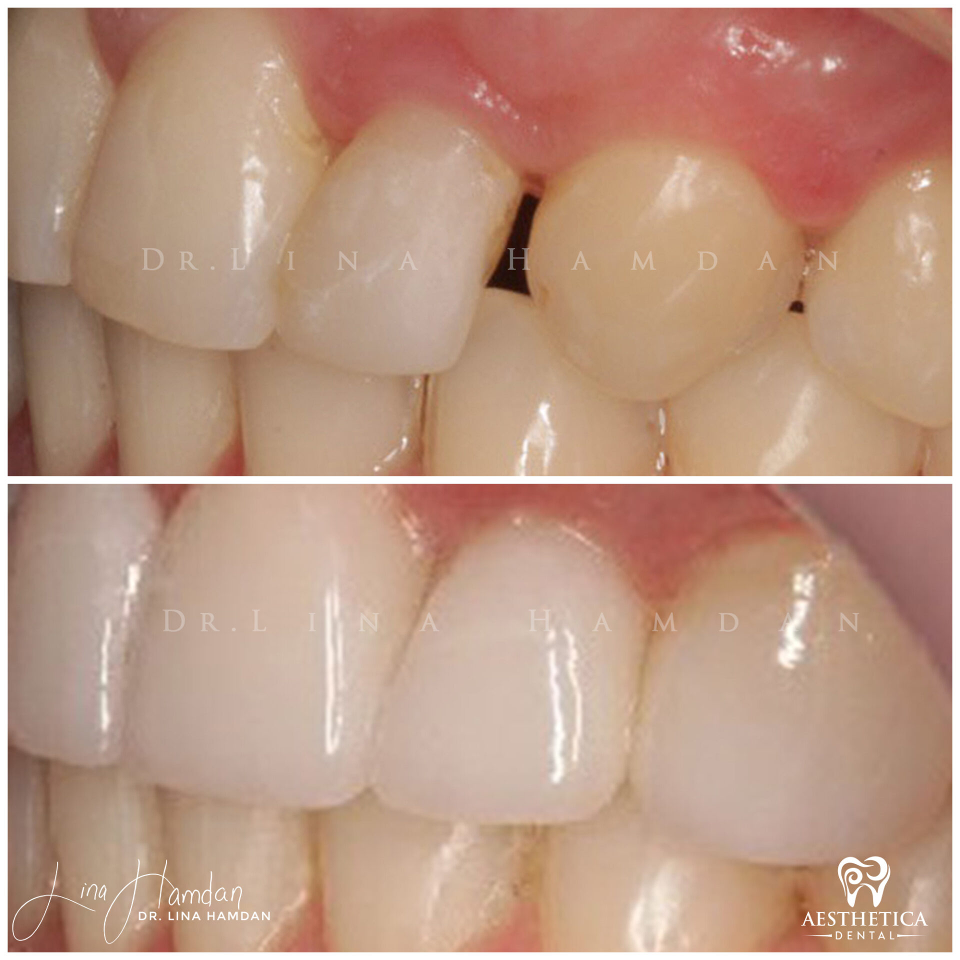 Porcelain Veneers case 10 done by Dr. Lina Hamdan. - Before and After Images - 3
