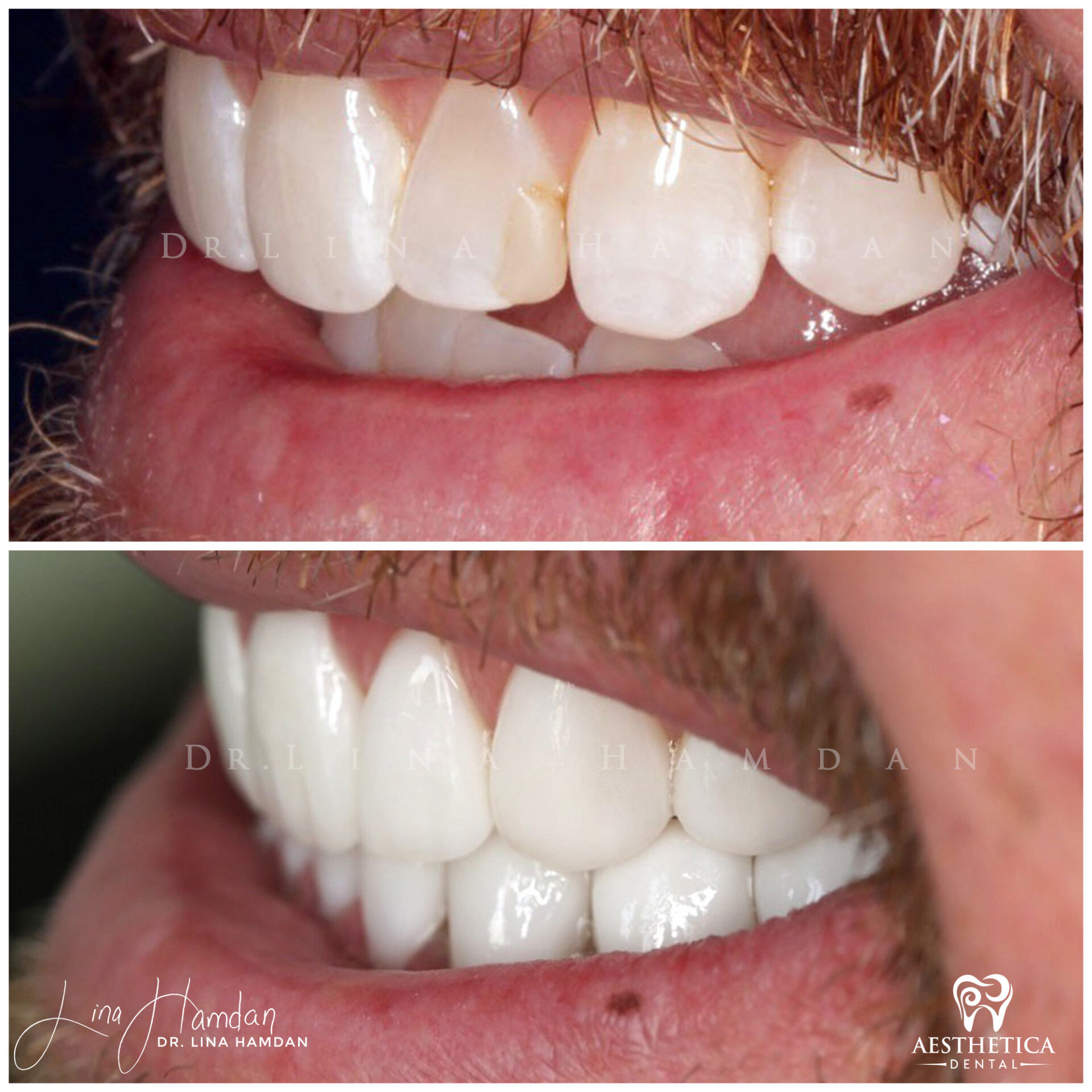 Porcelain Veneers case 1 done by Dr. Lina Hamdan. - Before and After Images - 5