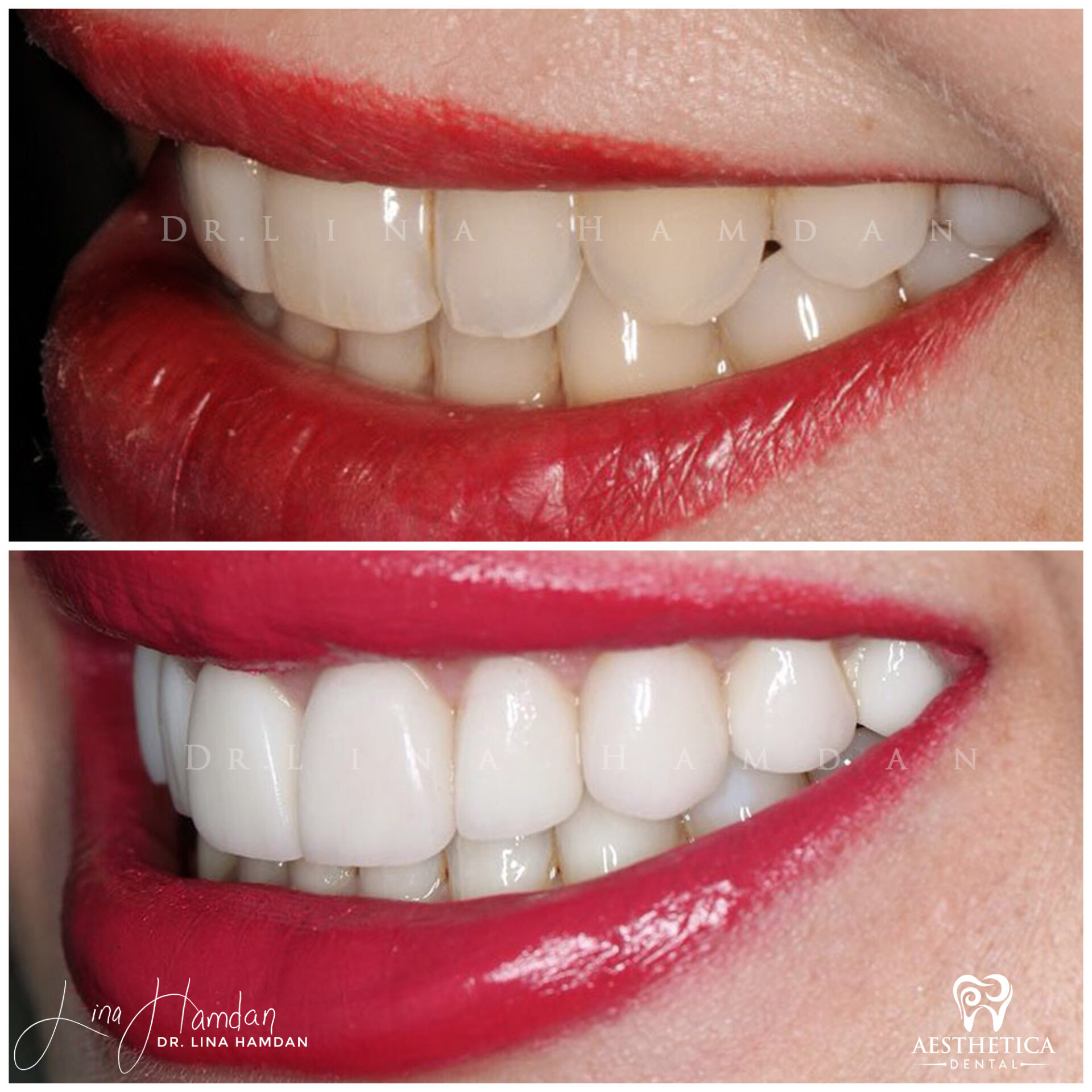 Porcelain Veneers case 7 done by Dr. Lina Hamdan. - Before and After Images - 5