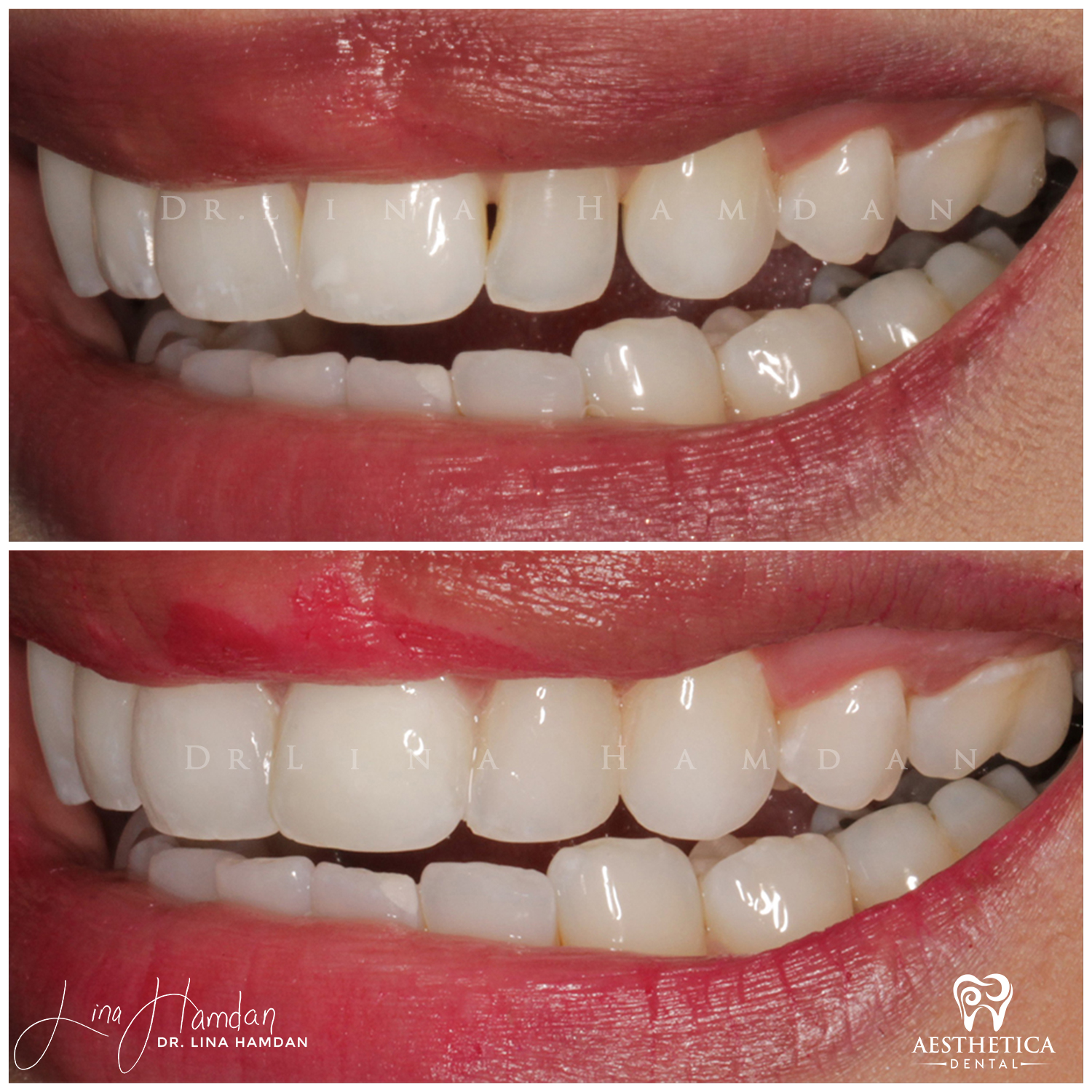 Dental Composite Bonding case done by Dr. Lina Hamdan. - Before and After Images - 2