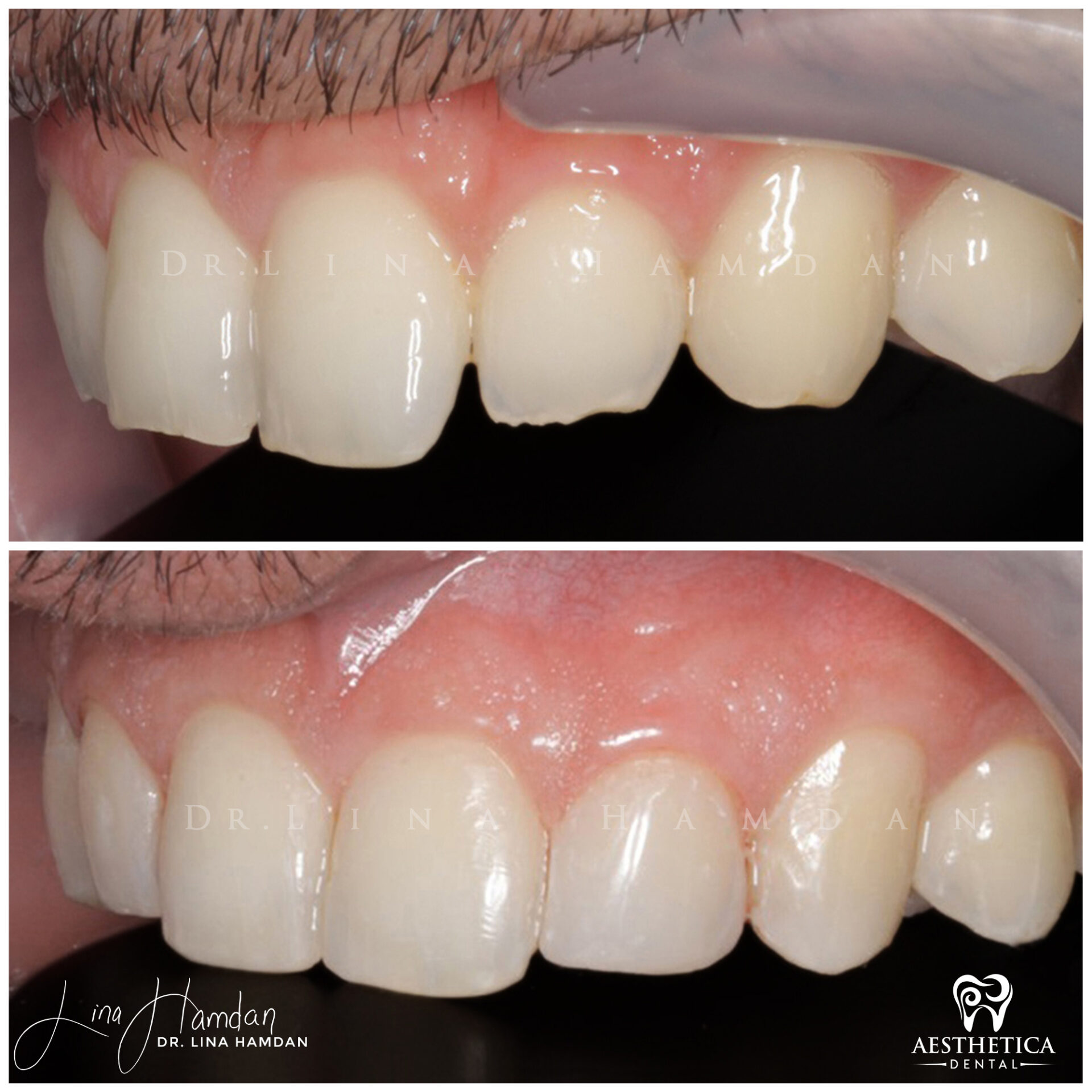 Dental Composite Bonding case 5 done by Dr. Lina Hamdan. - Before and After Images - 5