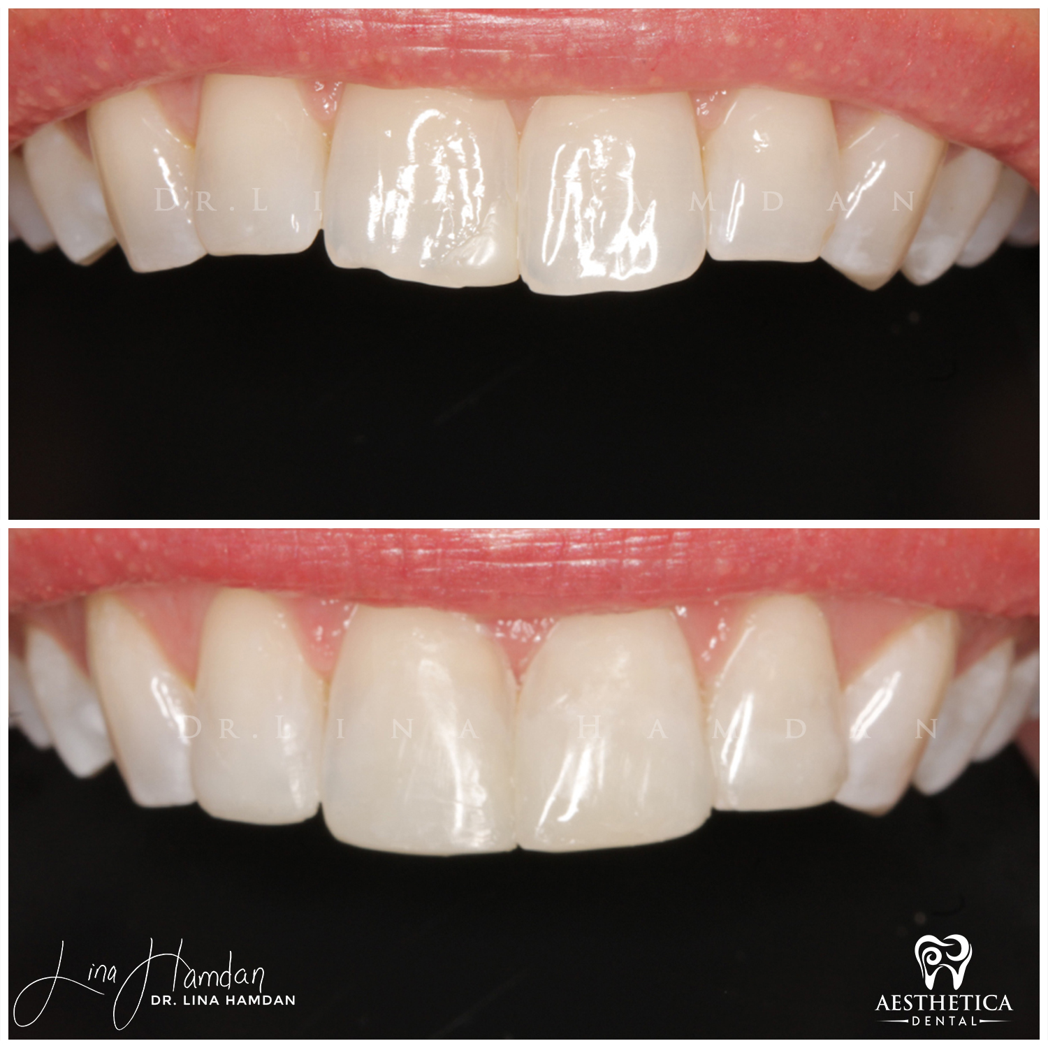 Dental Composite Bonding case 7 done by Dr. Lina Hamdan. - Before and After Images - 3