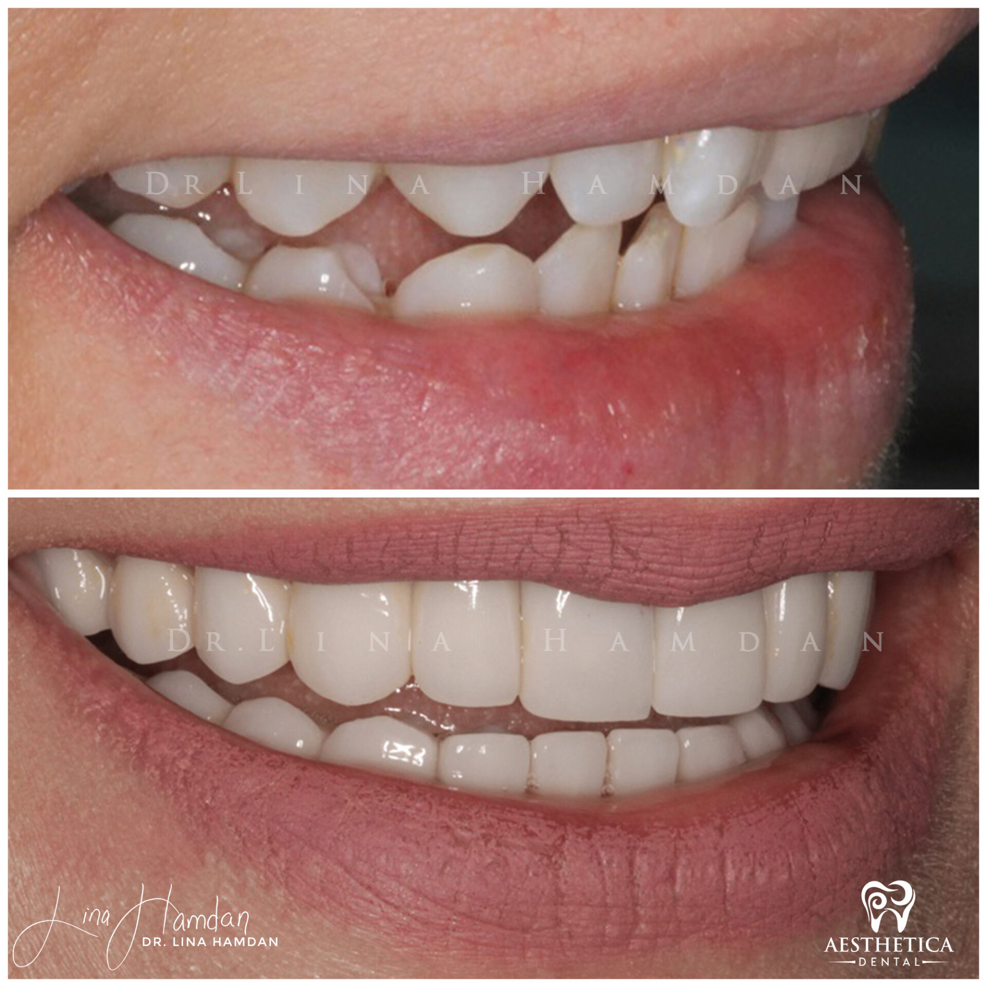 Inman Whitening Bonding. Case 4 done by Dr. Lina Hamdan. - Before and After Images - 5