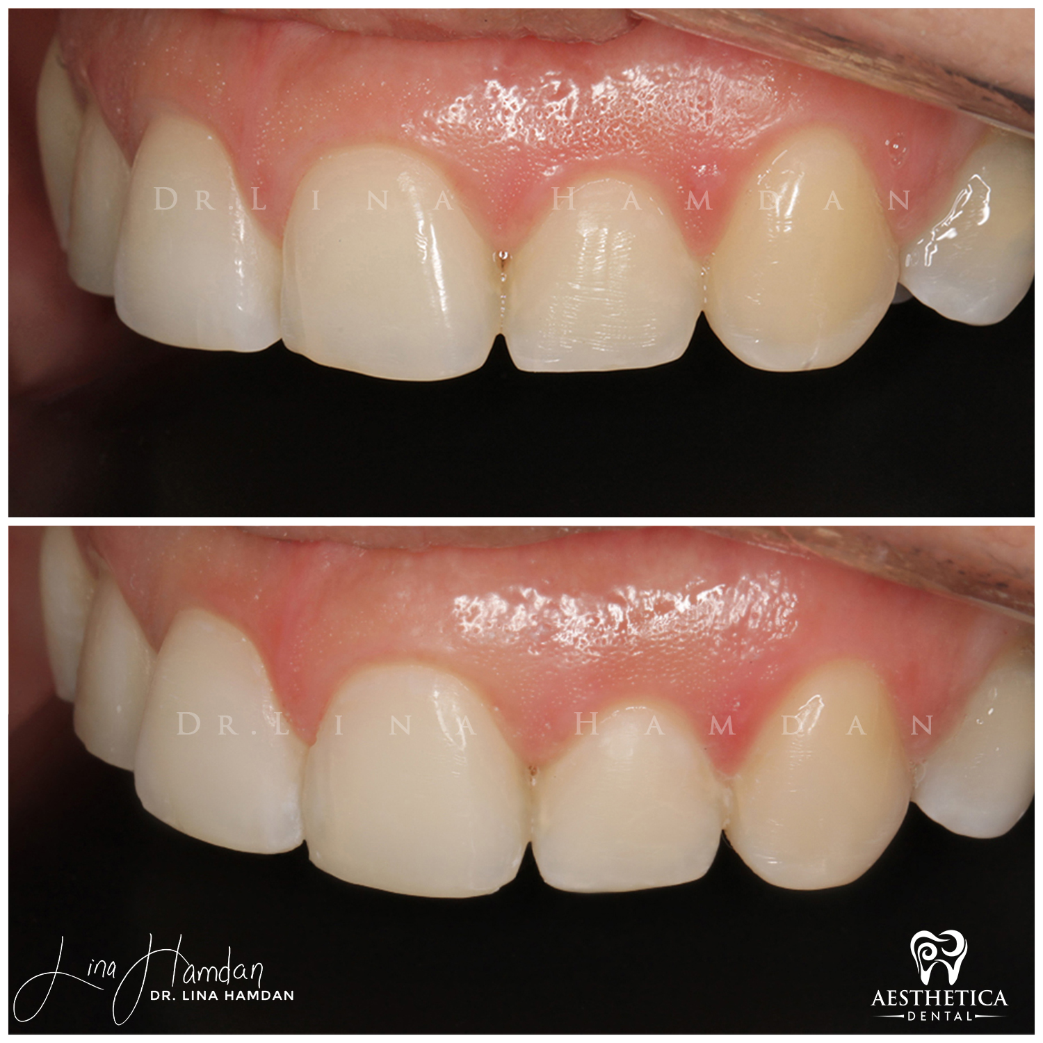 Dental Composite Bonding case 15 done by Dr. Lina Hamdan. - Before and After Images - 5