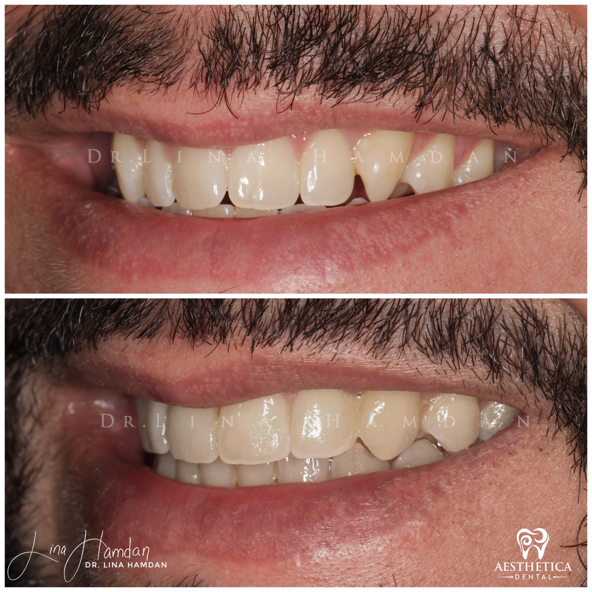 Dental Composite Bonding case 16 done by Dr. Lina Hamdan. - Before and After Images - 3