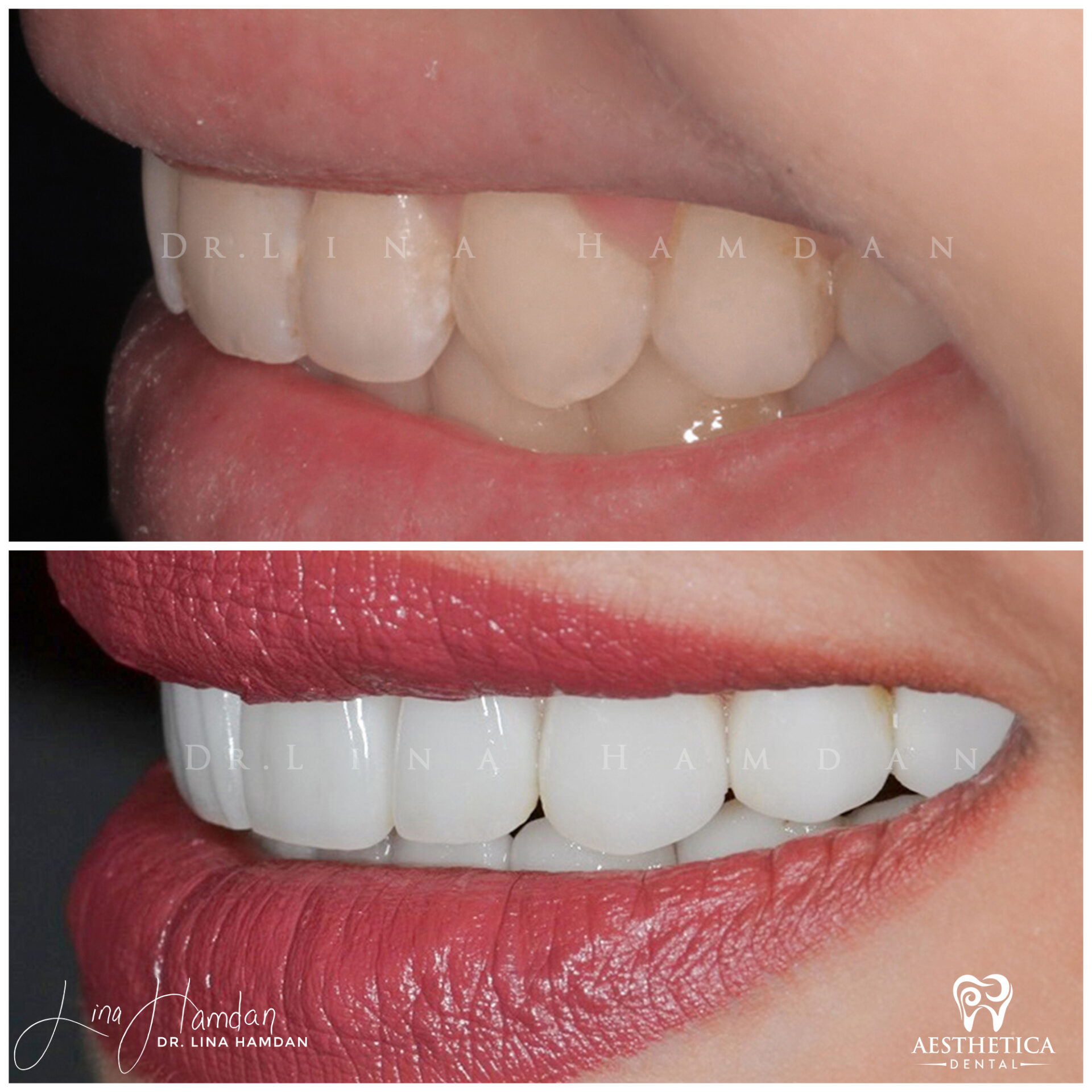 Porcelain Veneers case 3 done by Dr. Lina Hamdan. - Before and After Images - 6