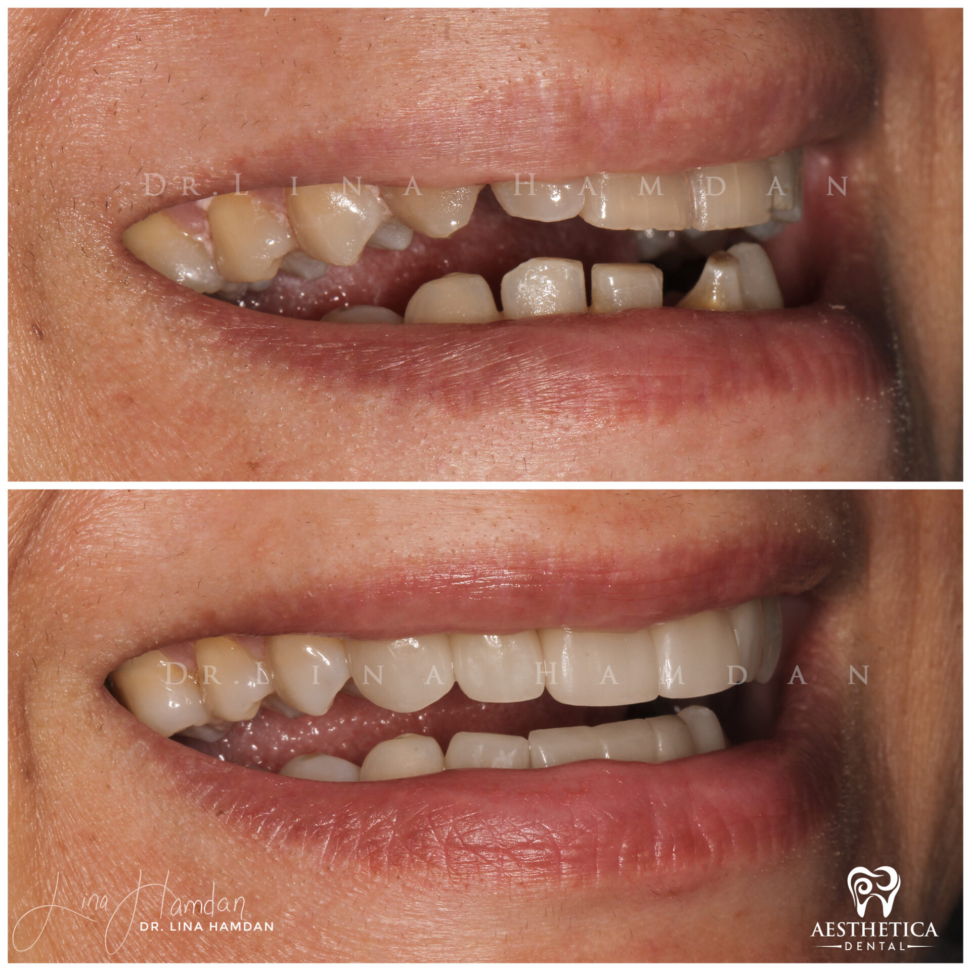 Porcelain Veneers case 5 done by Dr. Lina Hamdan. - Before and After Images - 5