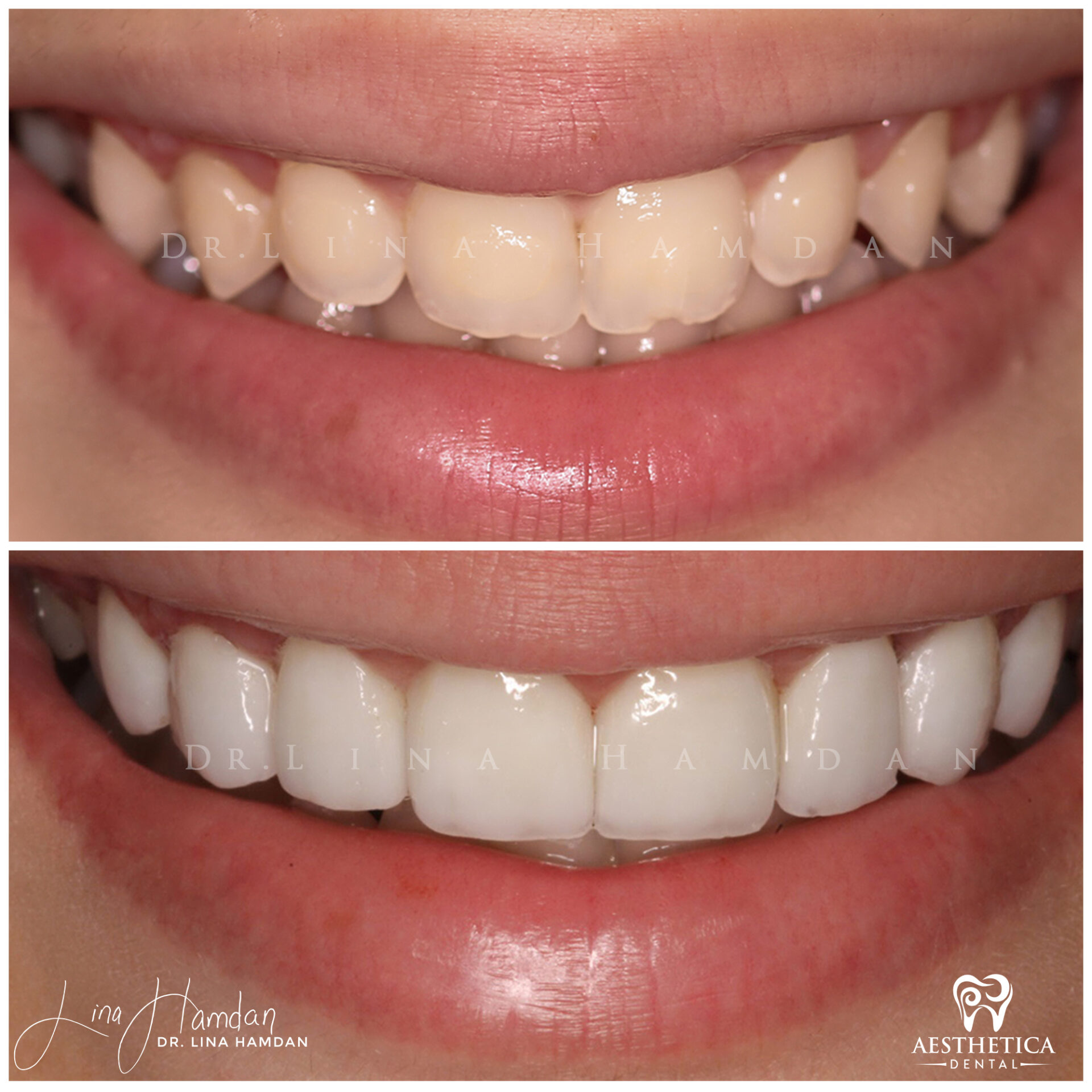 Porcelain Veneers case done by Dr. Lina Hamdan. - Before and After Images - 6
