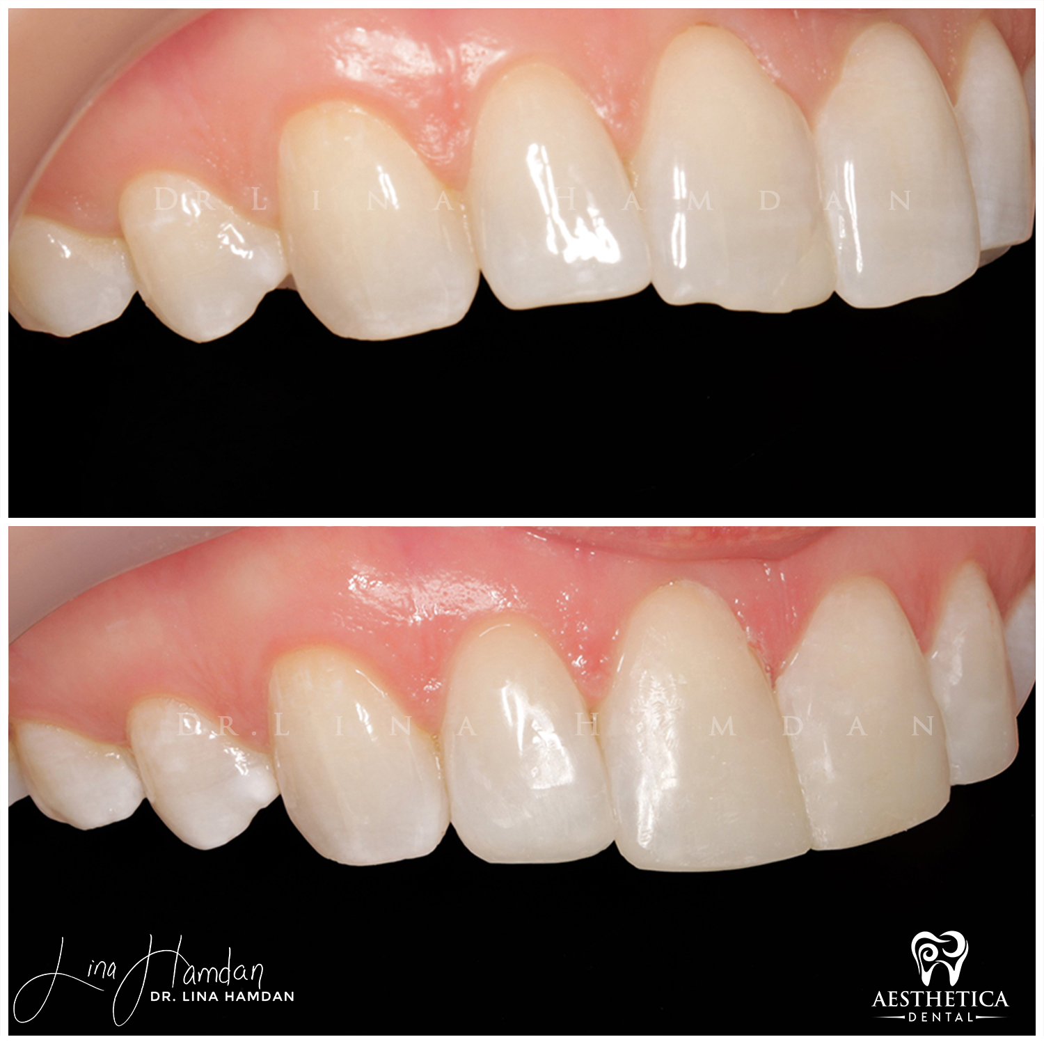 Dental Composite Bonding case 7 done by Dr. Lina Hamdan. - Before and After Images - 4