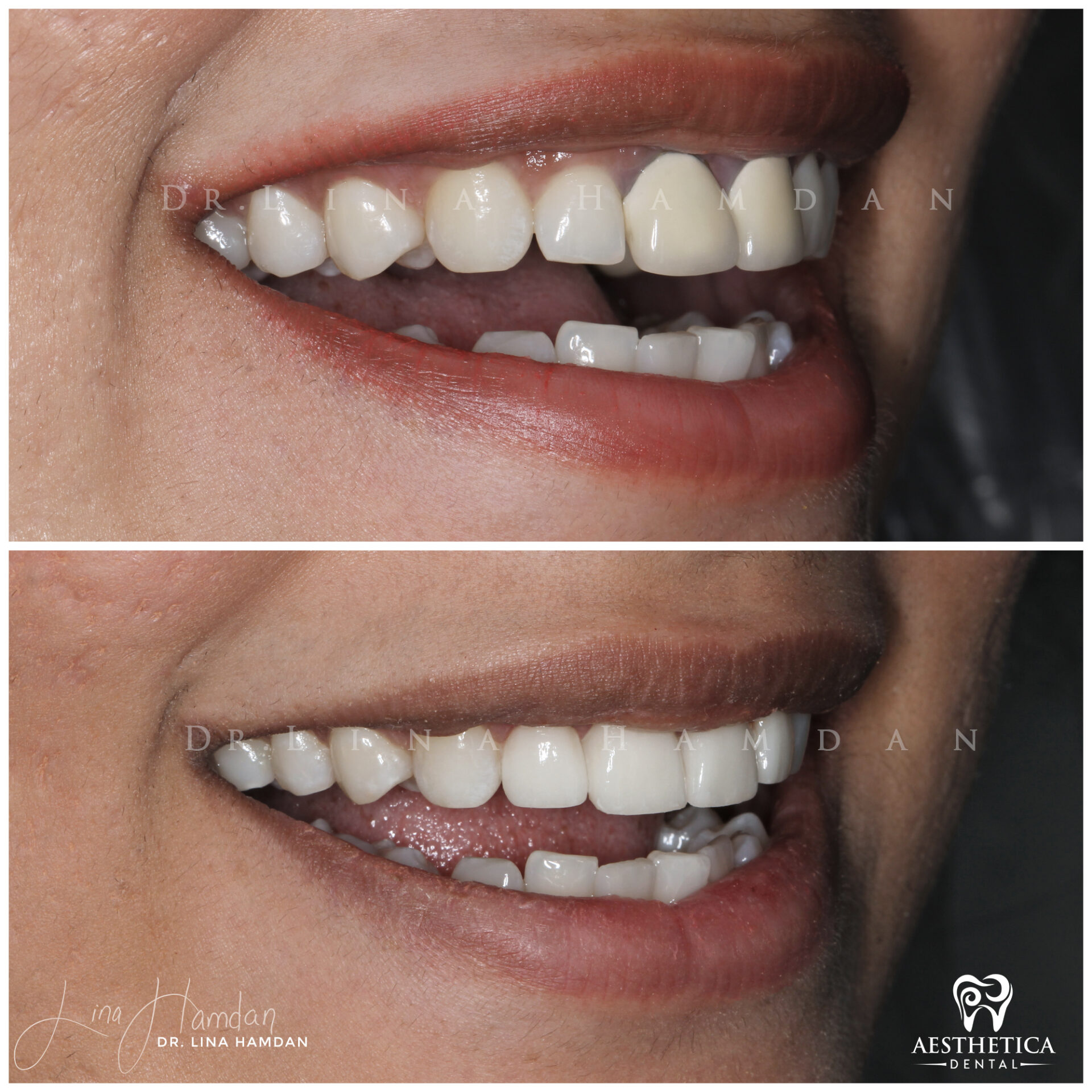 Porcelain Veneers case 8 done by Dr. Lina Hamdan. - Before and After Images - 5