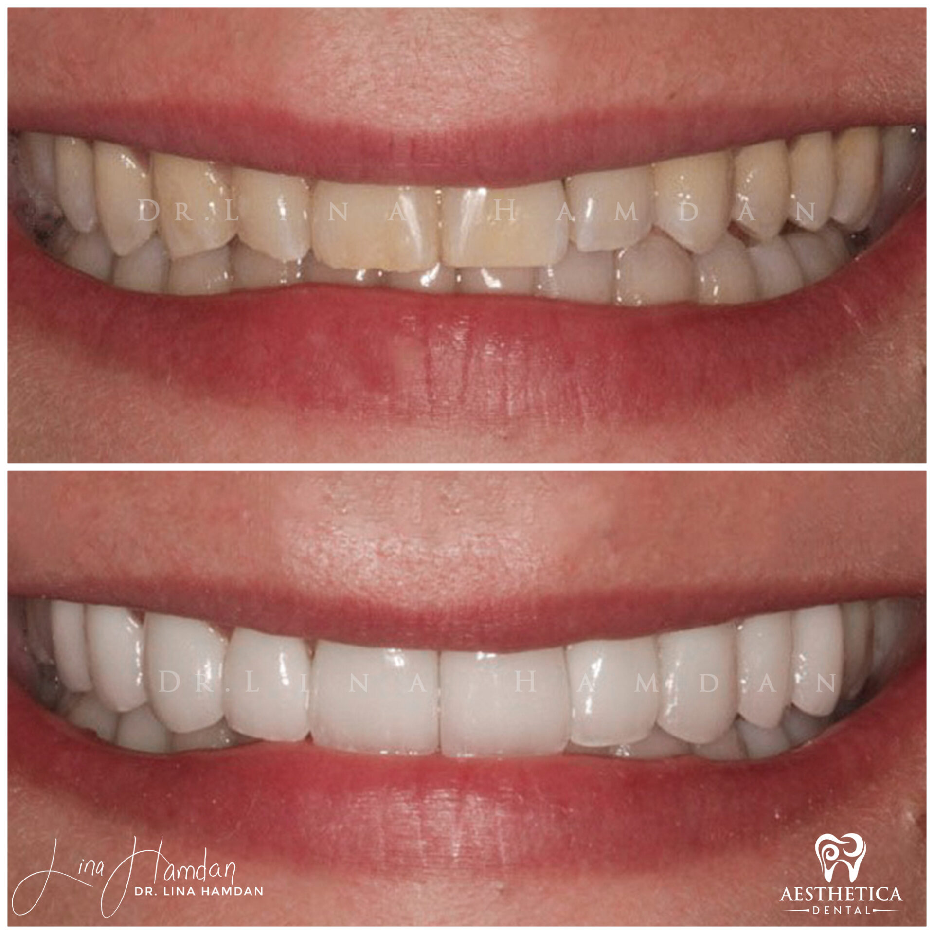 Porcelain Veneers case 4 done by Dr. Lina Hamdan. - Before and After Images - 7