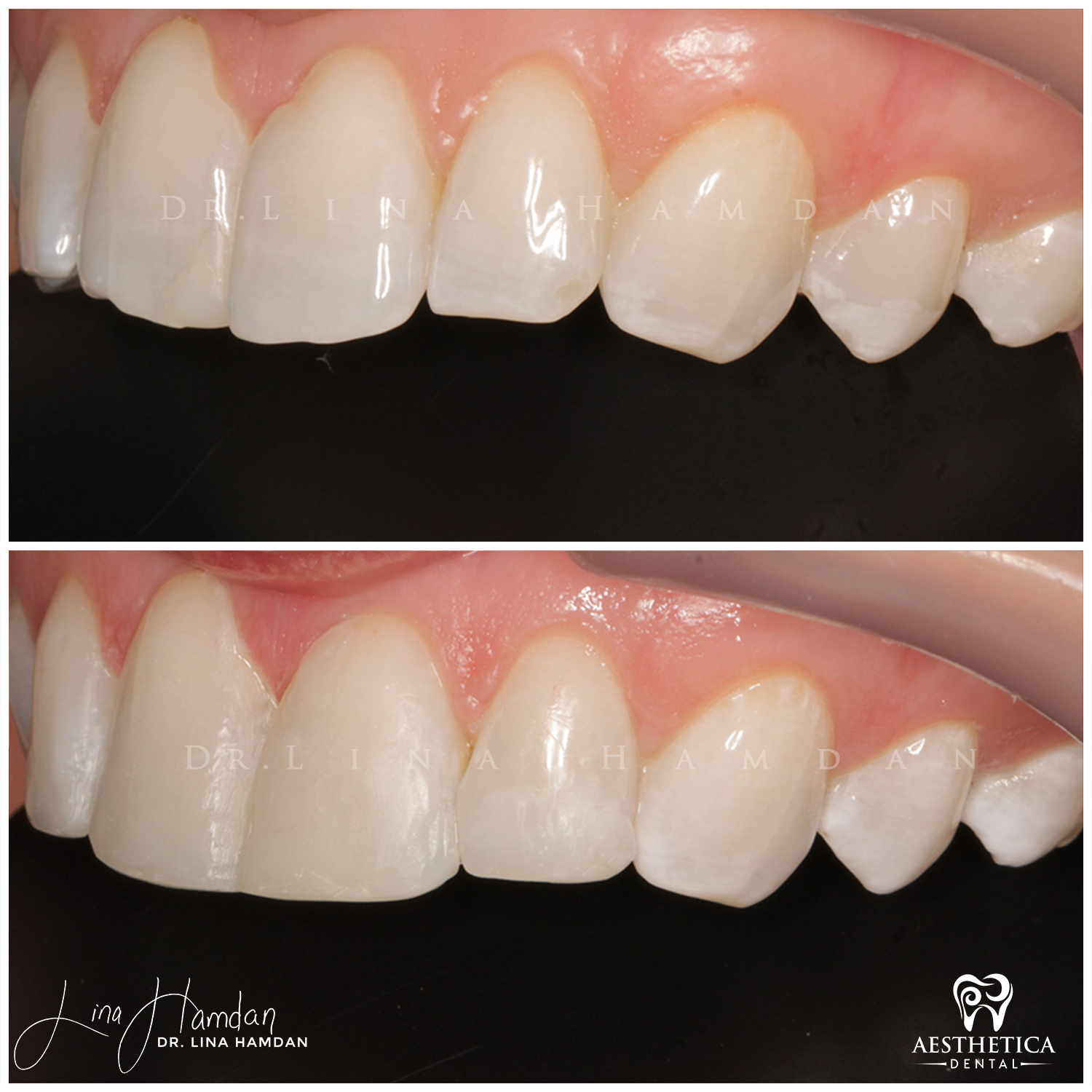 Dental Composite Bonding case 7 done by Dr. Lina Hamdan. - Before and After Images - 5
