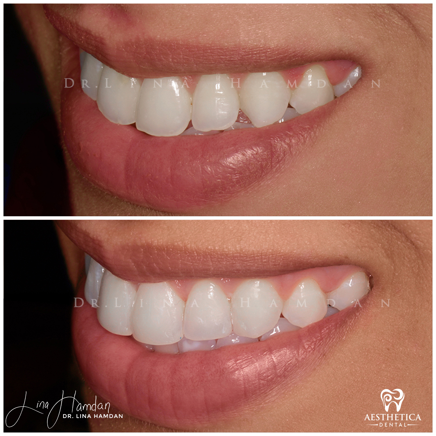 Dental Composite Bonding case 18 done by Dr. Lina Hamdan. - Before and After Images - 4