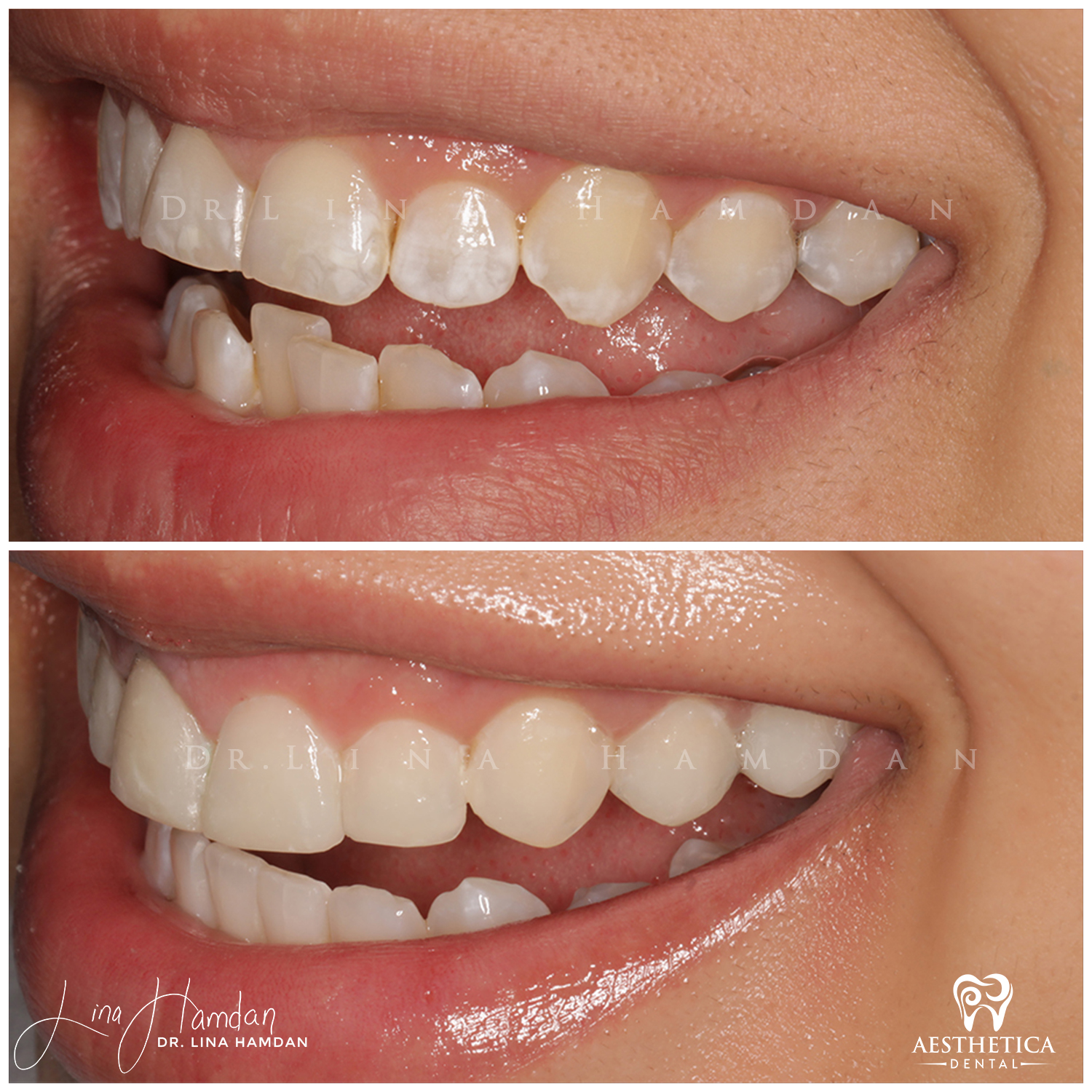 Inman Whitening Bonding. Case done by Dr. Lina Hamdan. - Before and After Images - 5