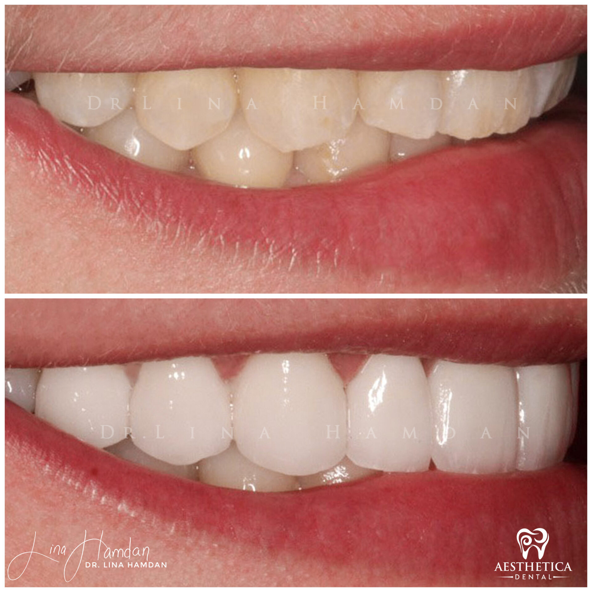 Porcelain Veneers case 4 done by Dr. Lina Hamdan. - Before and After Images - 8