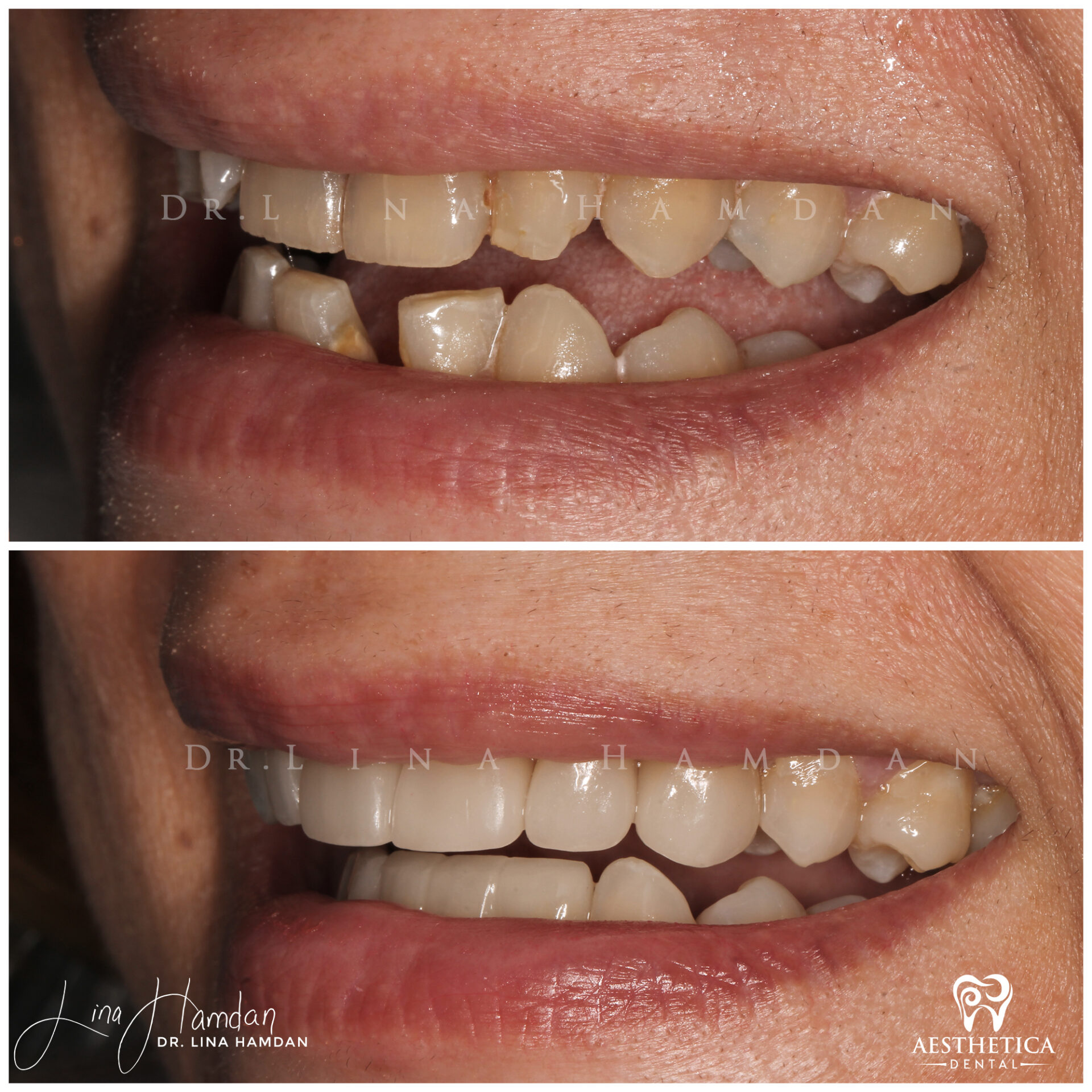 Porcelain Veneers case 5 done by Dr. Lina Hamdan. - Before and After Images - 6