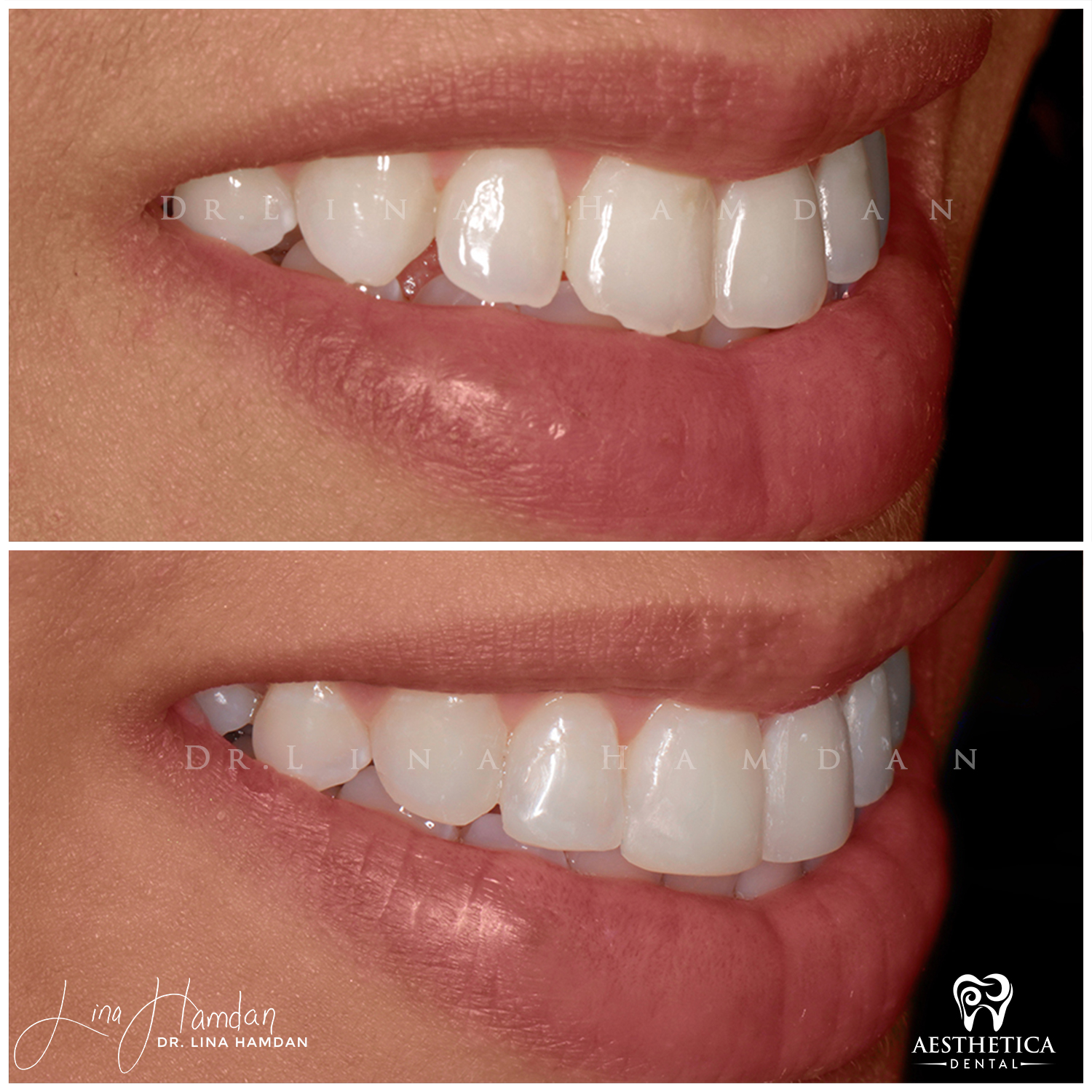 Dental Composite Bonding case 18 done by Dr. Lina Hamdan. - Before and After Images - 5