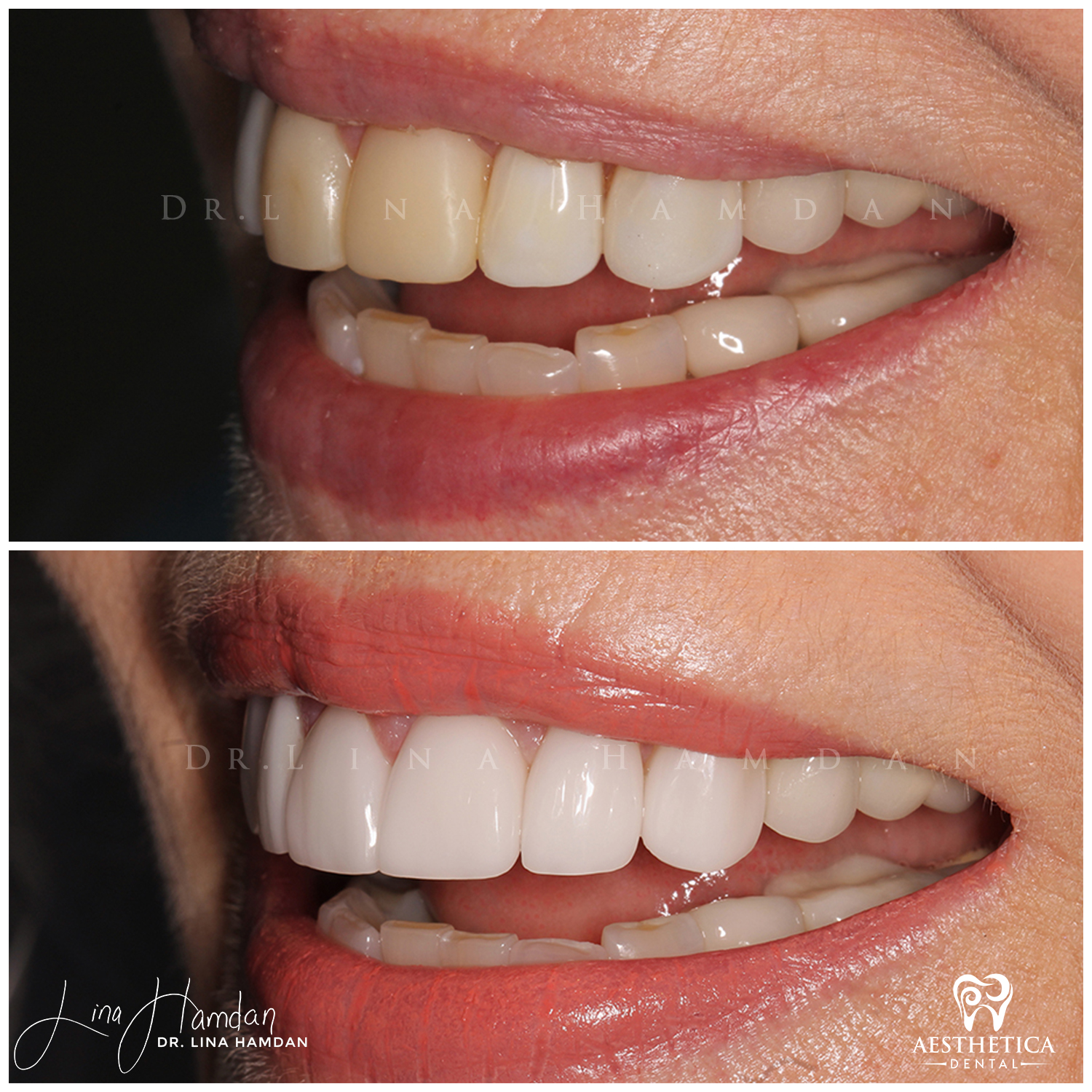 Porcelain Veneers case 2 done by Dr. Lina Hamdan. - Before and After Images - 4