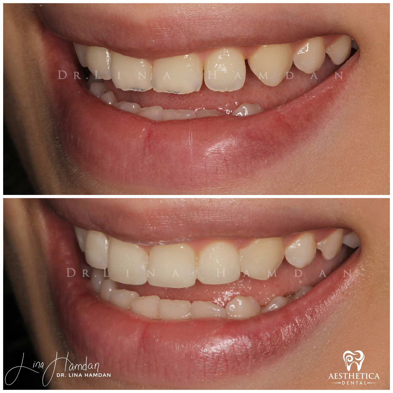 Dental Composite Bonding case 2 done by Dr. Lina Hamdan. - Before and After Images - 6