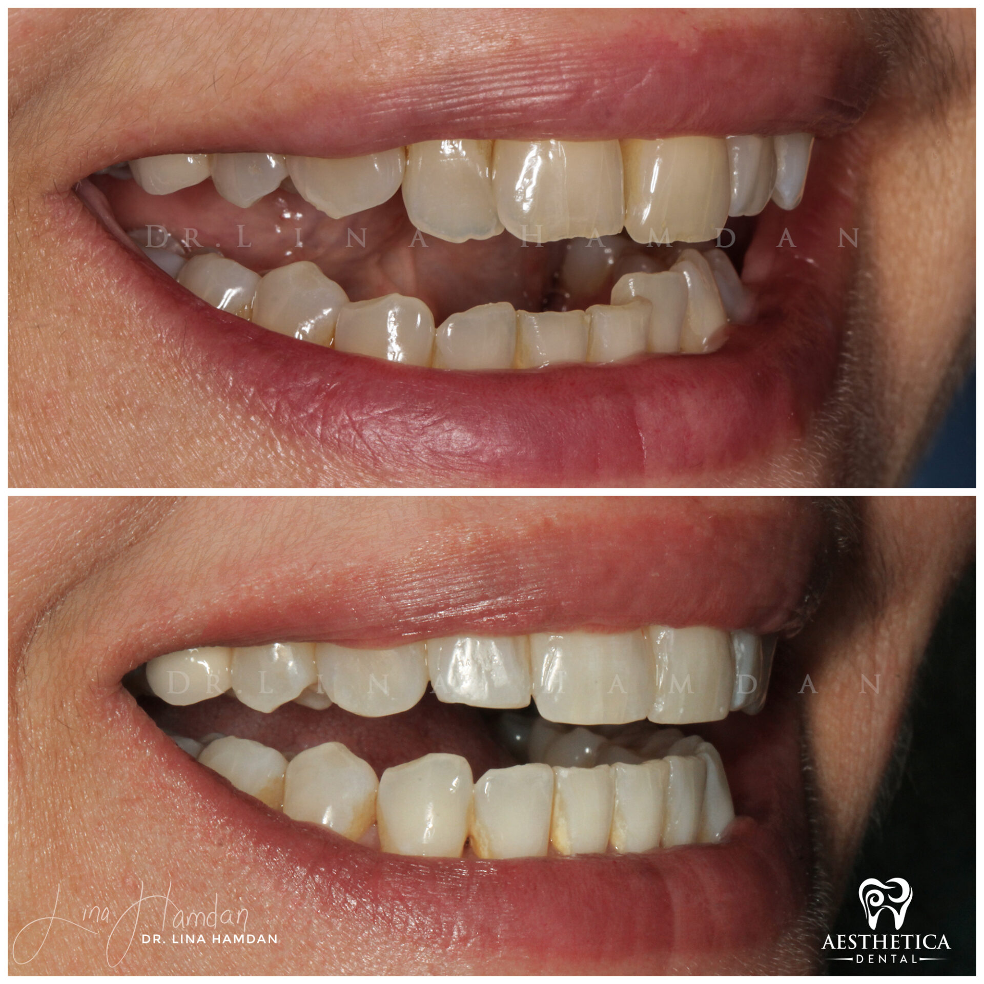 Invisalign Whitening Bonding. Case 5 done by Dr. Lina Hamdan. - Before and After Images - 6
