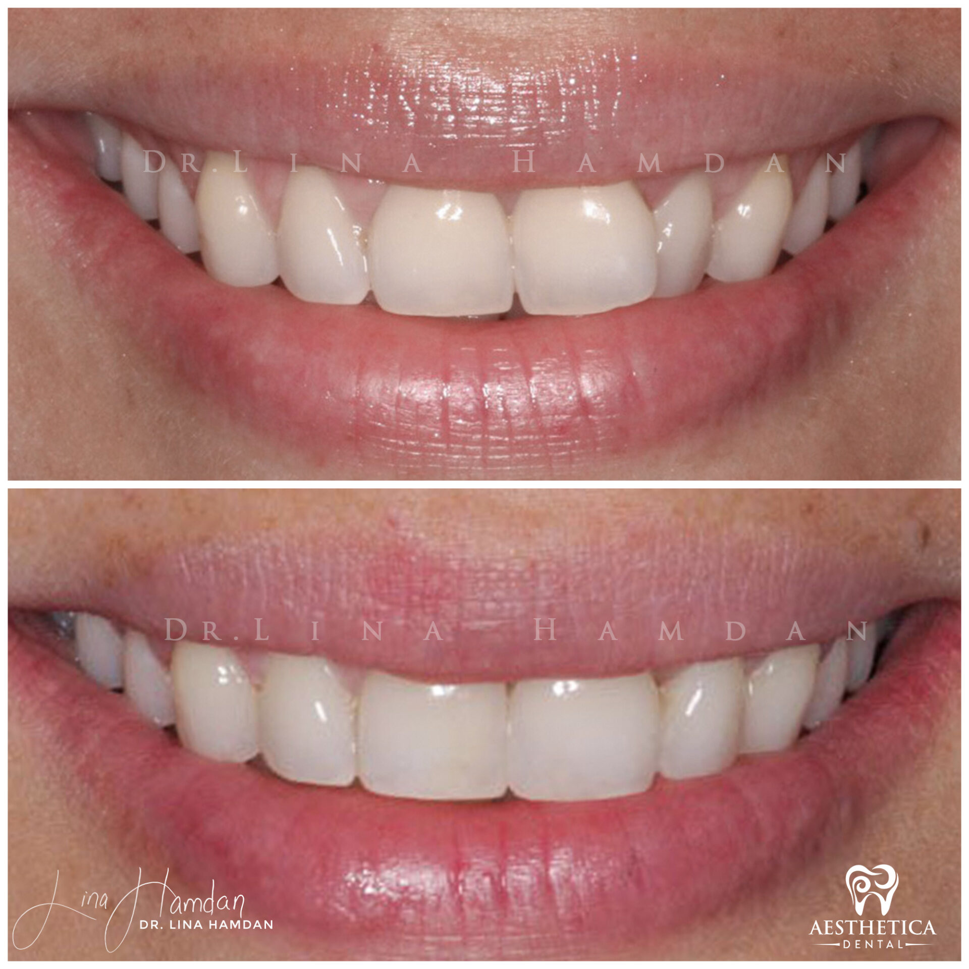 Inman Aligner. Case 10 done by Dr. Lina Hamdan. - Before and After Images - 8