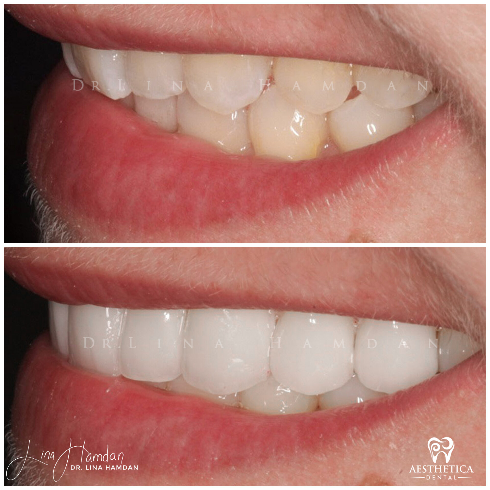 Porcelain Veneers case 4 done by Dr. Lina Hamdan. - Before and After Images - 9