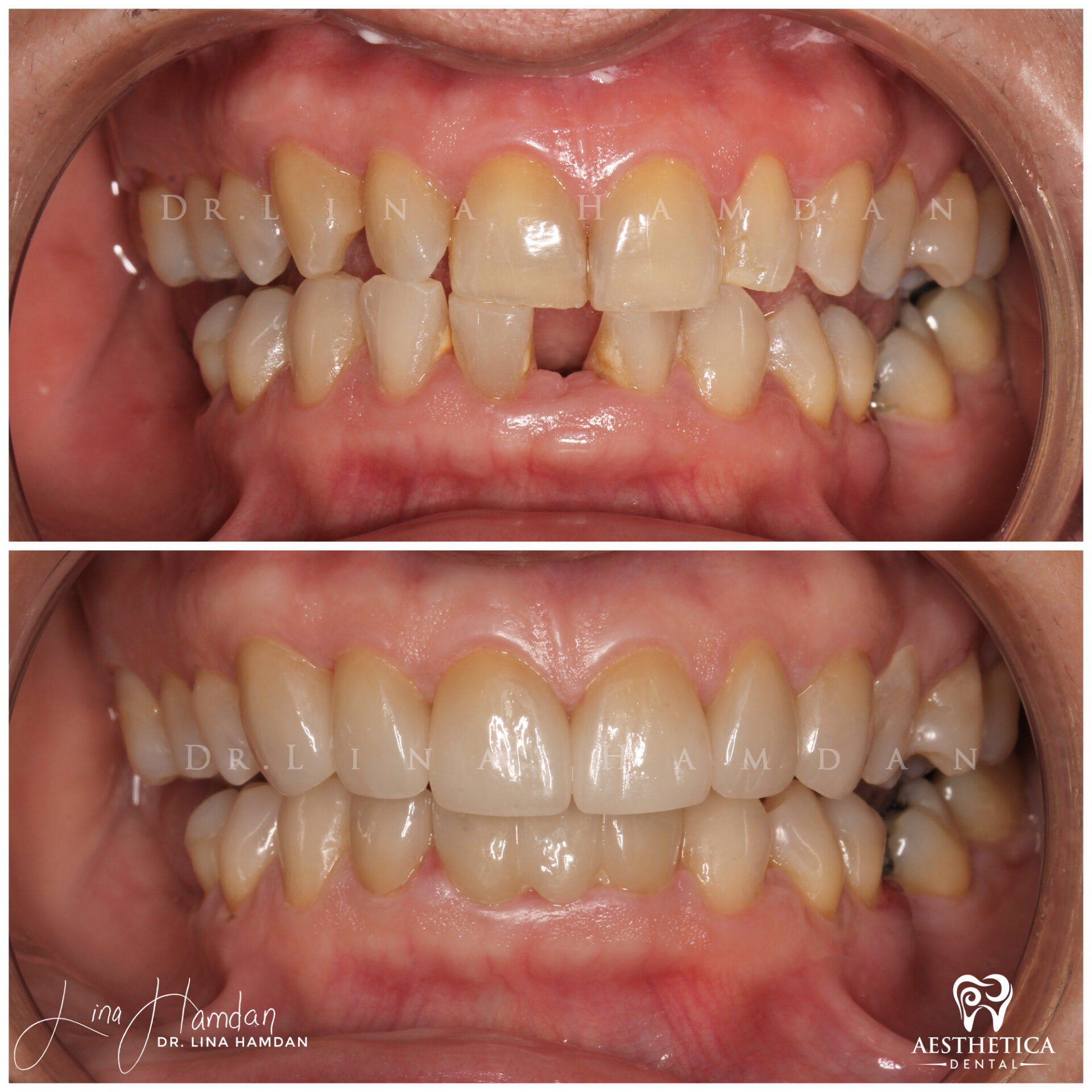 Porcelain Veneers case 5 done by Dr. Lina Hamdan. - Before and After Images - 7