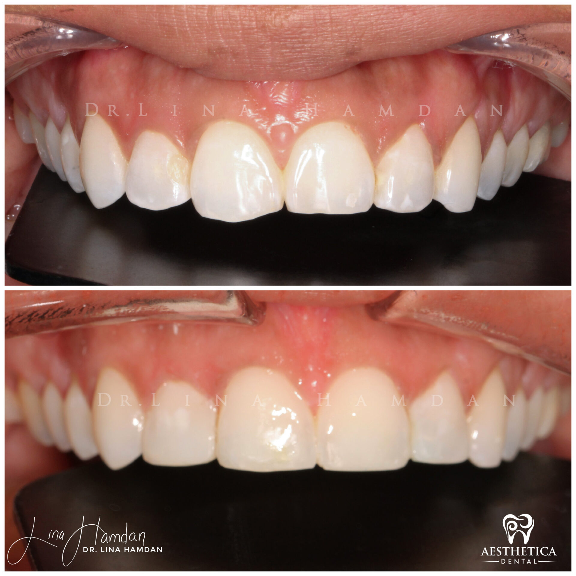 Dental Composite Bonding case 21 done by Dr. Lina Hamdan. - Before and After Images - 4