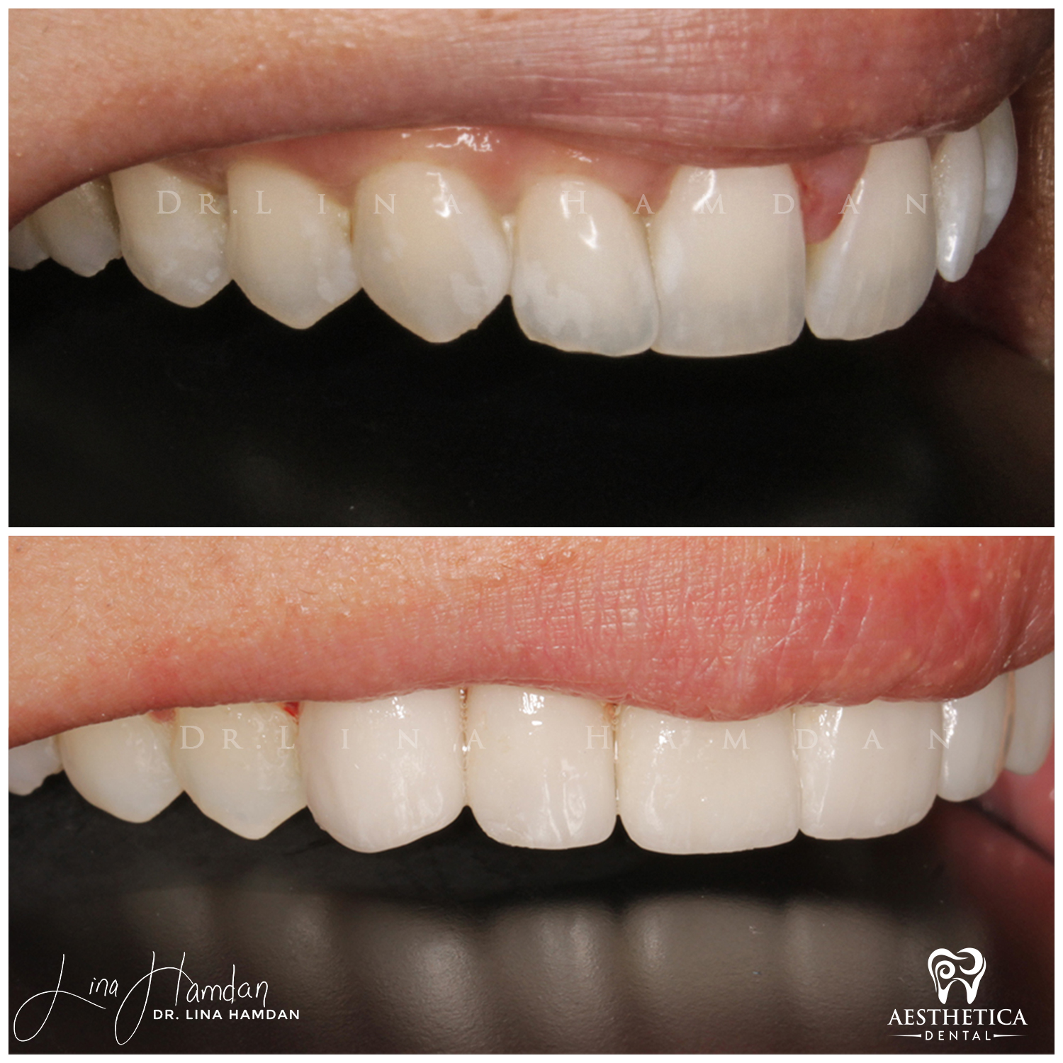 Porcelain Veneers case 9 done by Dr. Lina Hamdan. - Before and After Images - 6