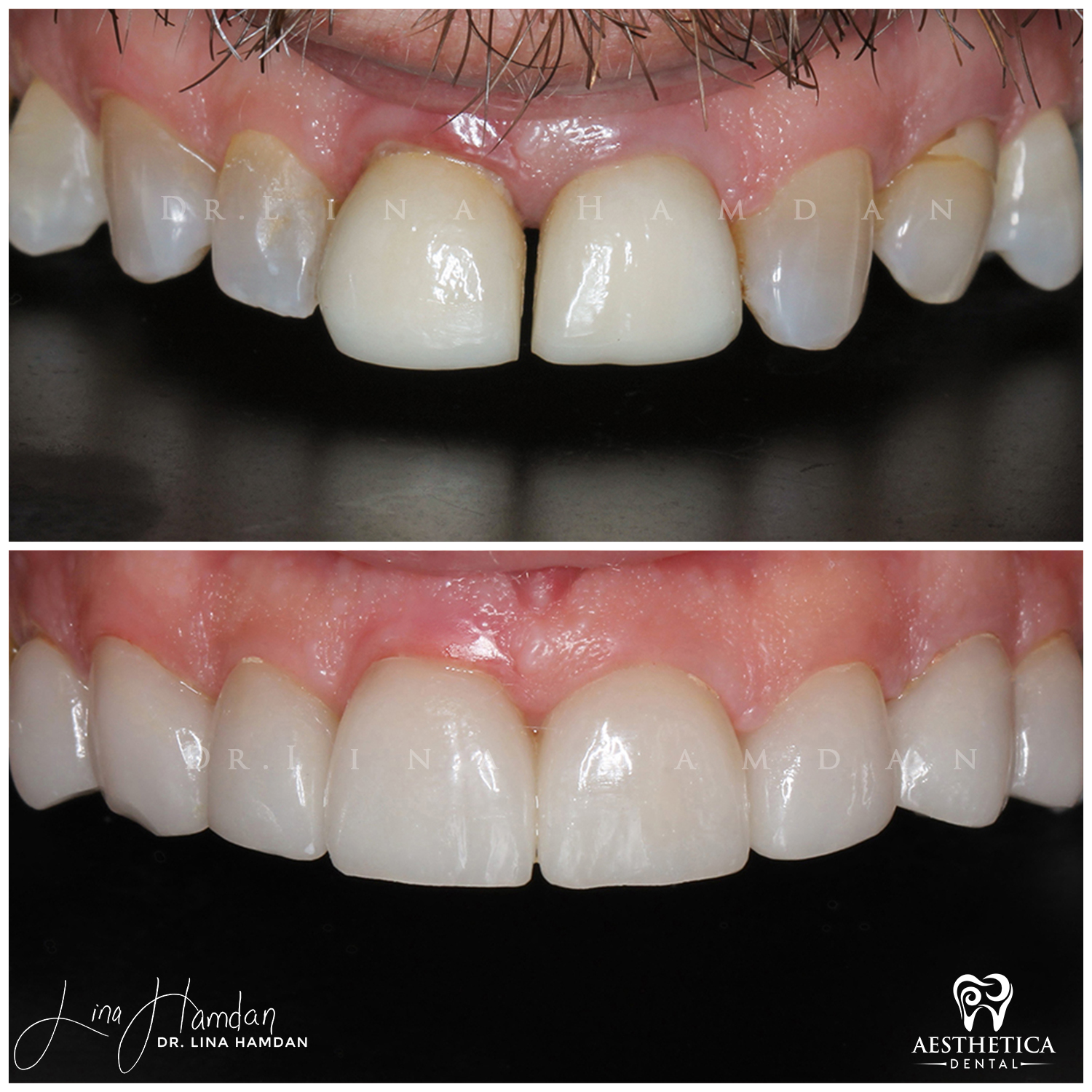 Porcelain Veneers case 6 done by Dr. Lina Hamdan. - Before and After Images - 4