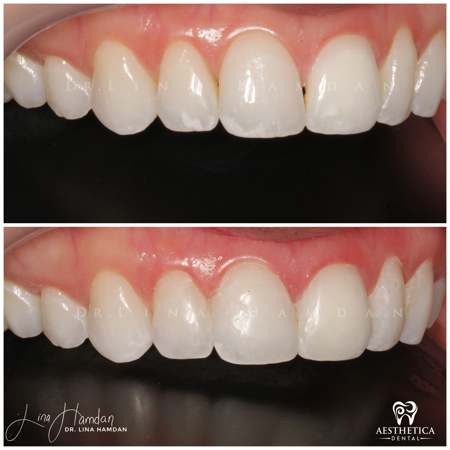 Dental Composite Bonding case done by Dr. Lina Hamdan. - Before and After Images - 6