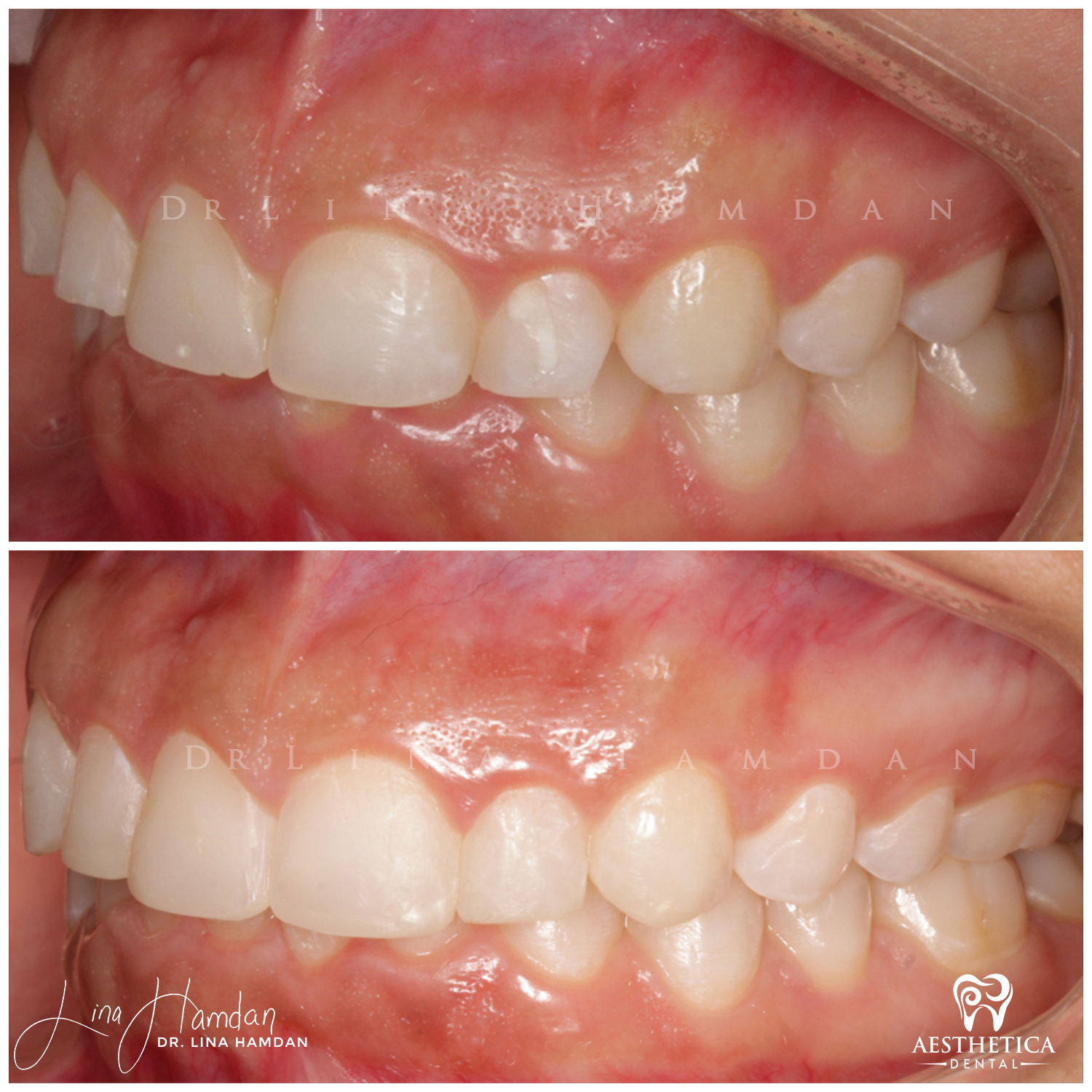 Inman Whitening Bonding. Case 6 done by Dr. Lina Hamdan. - Before and After Images - 11