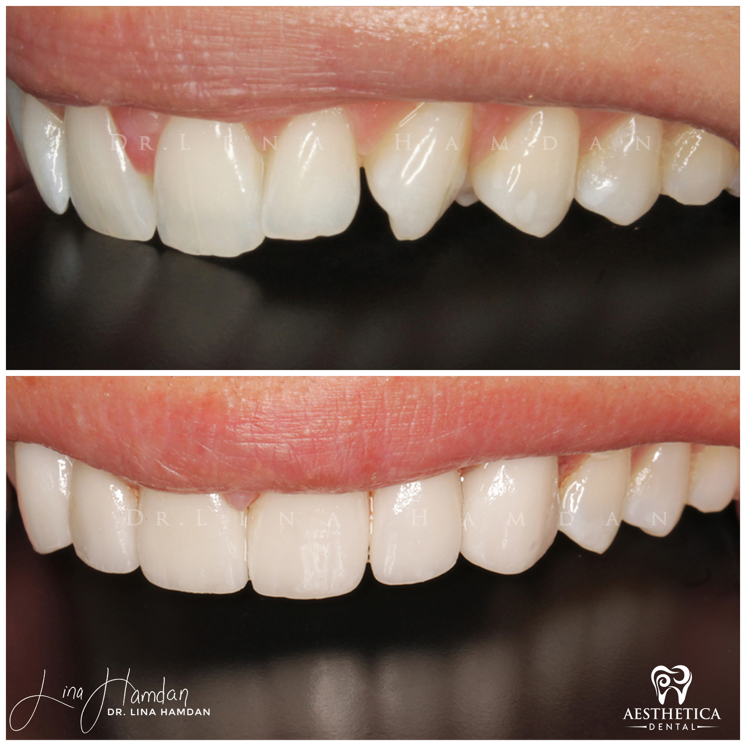 Porcelain Veneers case 9 done by Dr. Lina Hamdan. - Before and After Images - 7