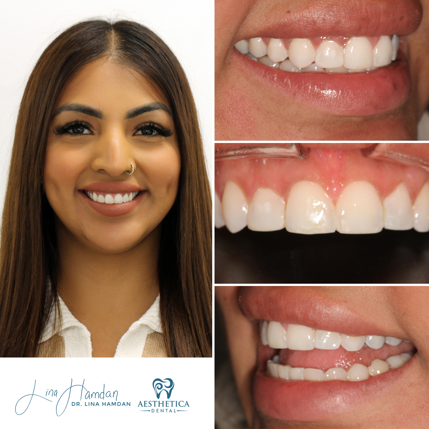 Dental Composite Bonding case 21 done by Dr. Lina Hamdan. - Before and After Images - 2