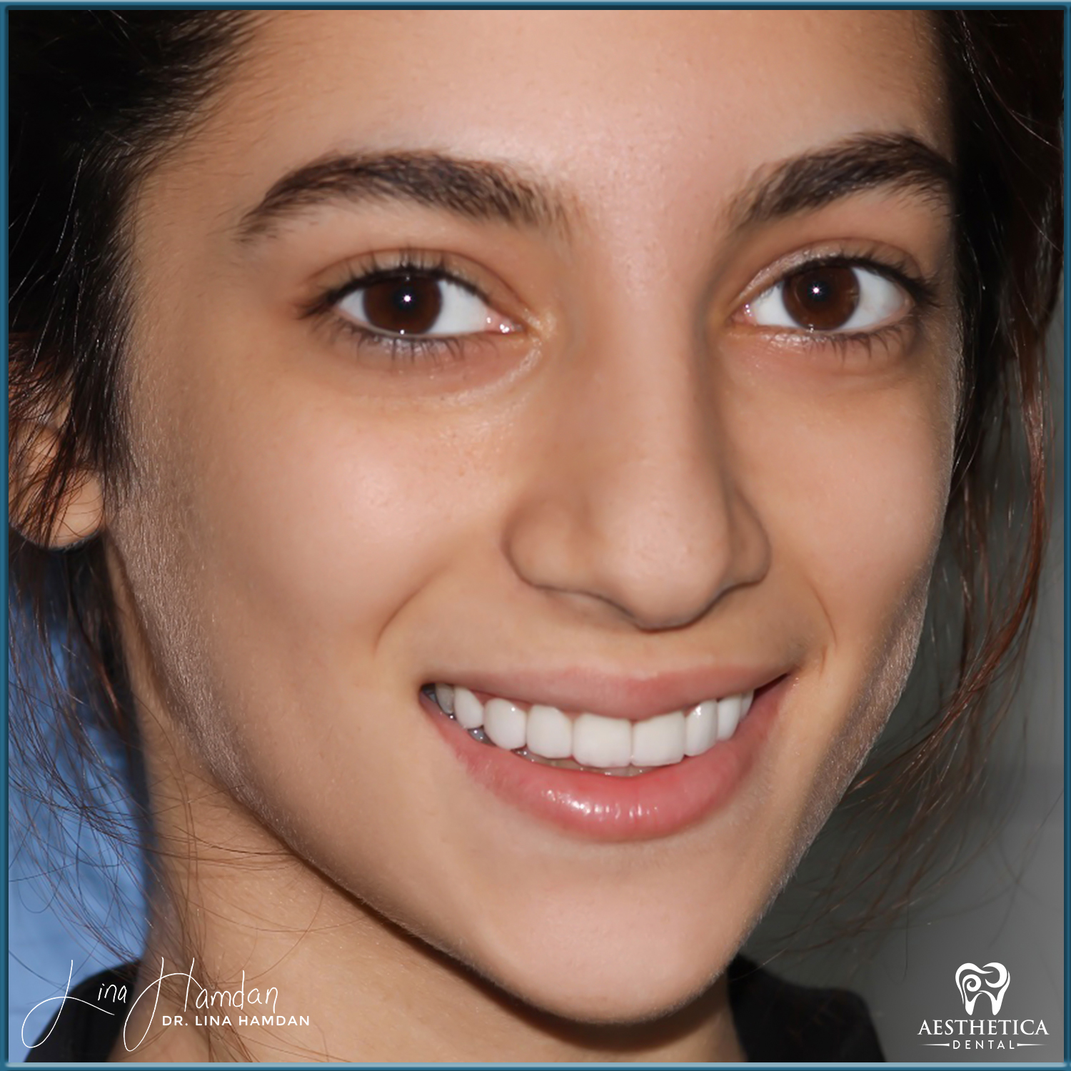 Porcelain Veneers case done by Dr. Lina Hamdan. - Before and After Images - 1