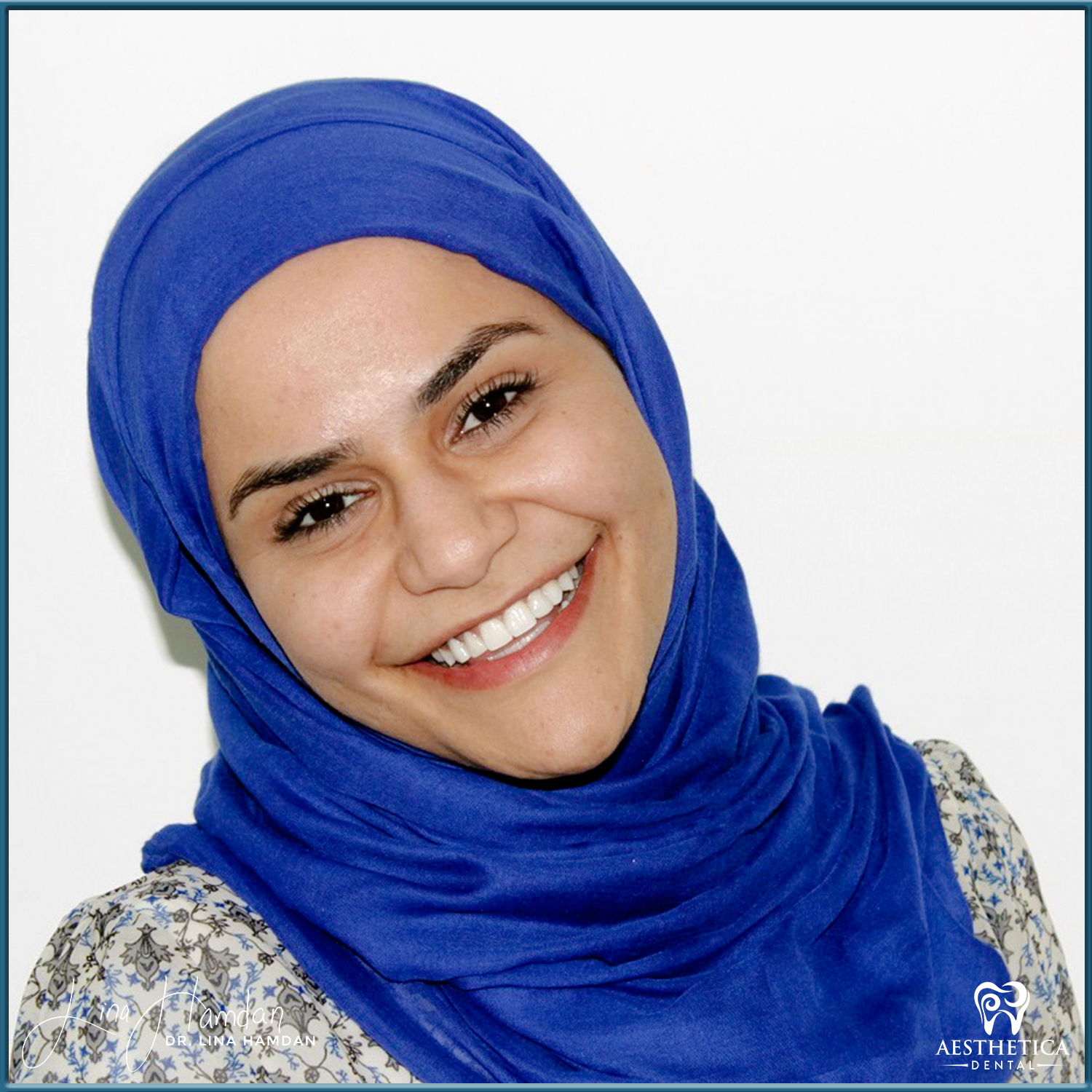 Gingivectomy. Case 11 done by Dr. Lina Hamdan. - Before and After Images - 1