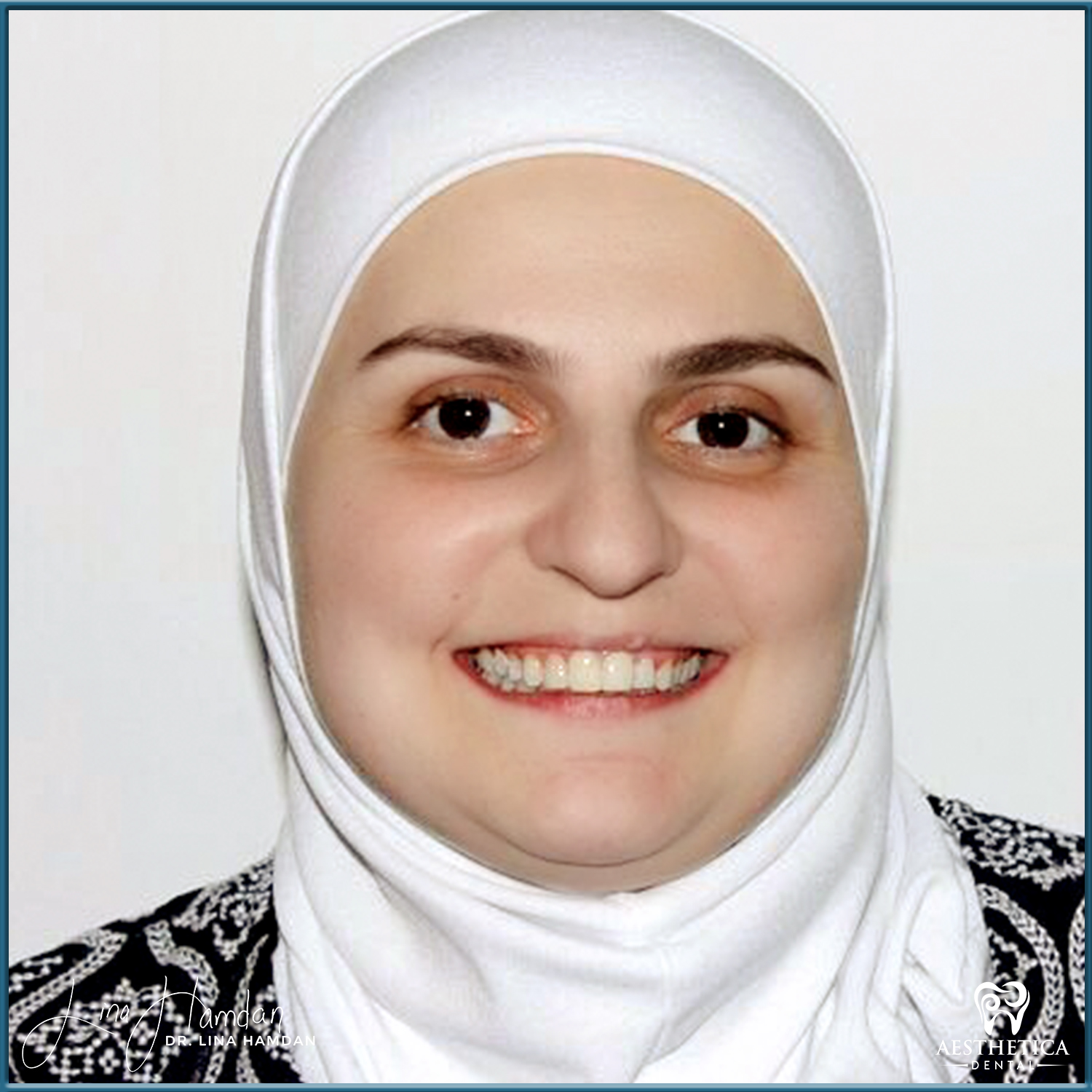 Dental Composite Bonding case 19 done by Dr. Lina Hamdan. - Before and After Images - 1