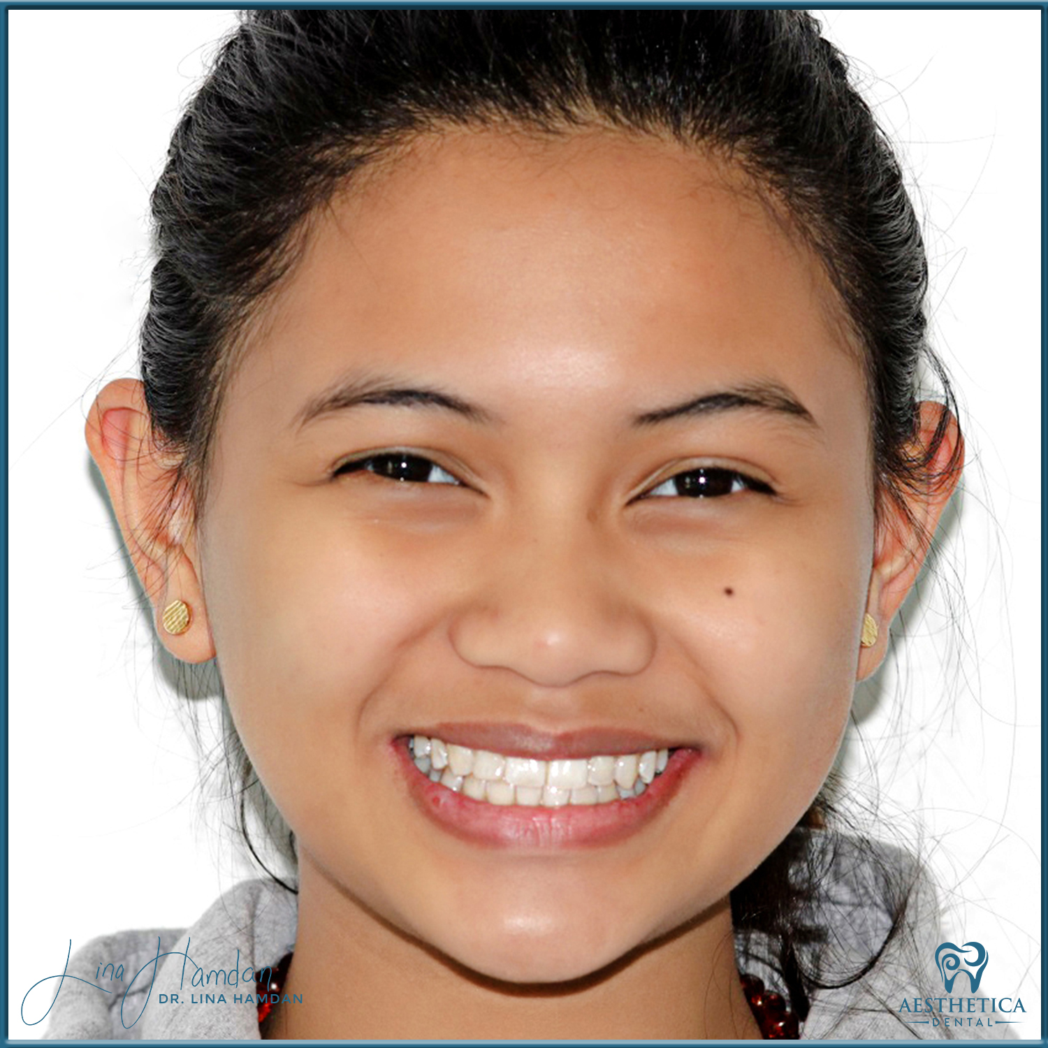 Dental Composite Bonding case 20 done by Dr. Lina Hamdan. - Before and After Images - 1