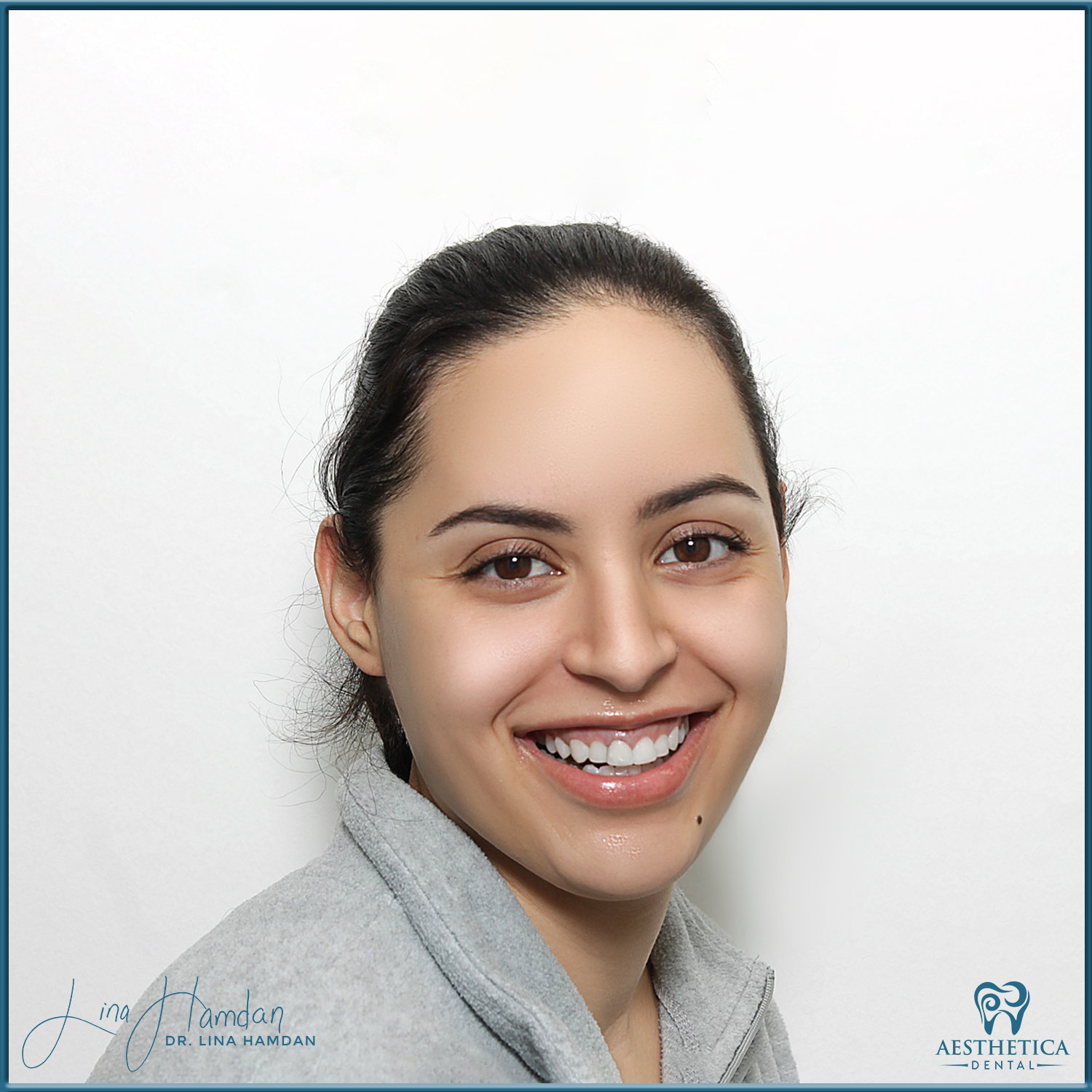 Inman Whitening Bonding. Case done by Dr. Lina Hamdan. - Before and After Images - 1