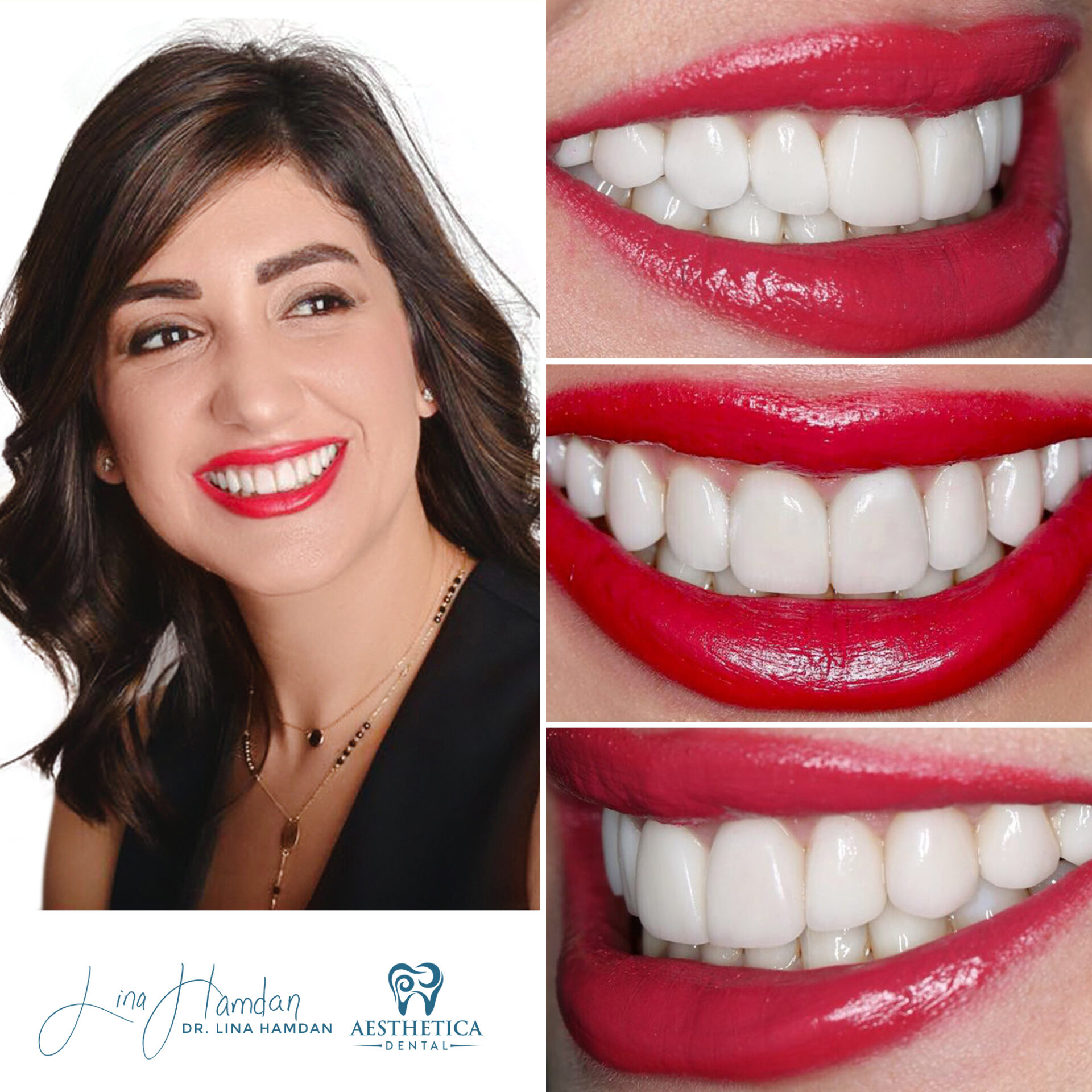 Porcelain Veneers case 7 done by Dr. Lina Hamdan. - Before and After Images - 2
