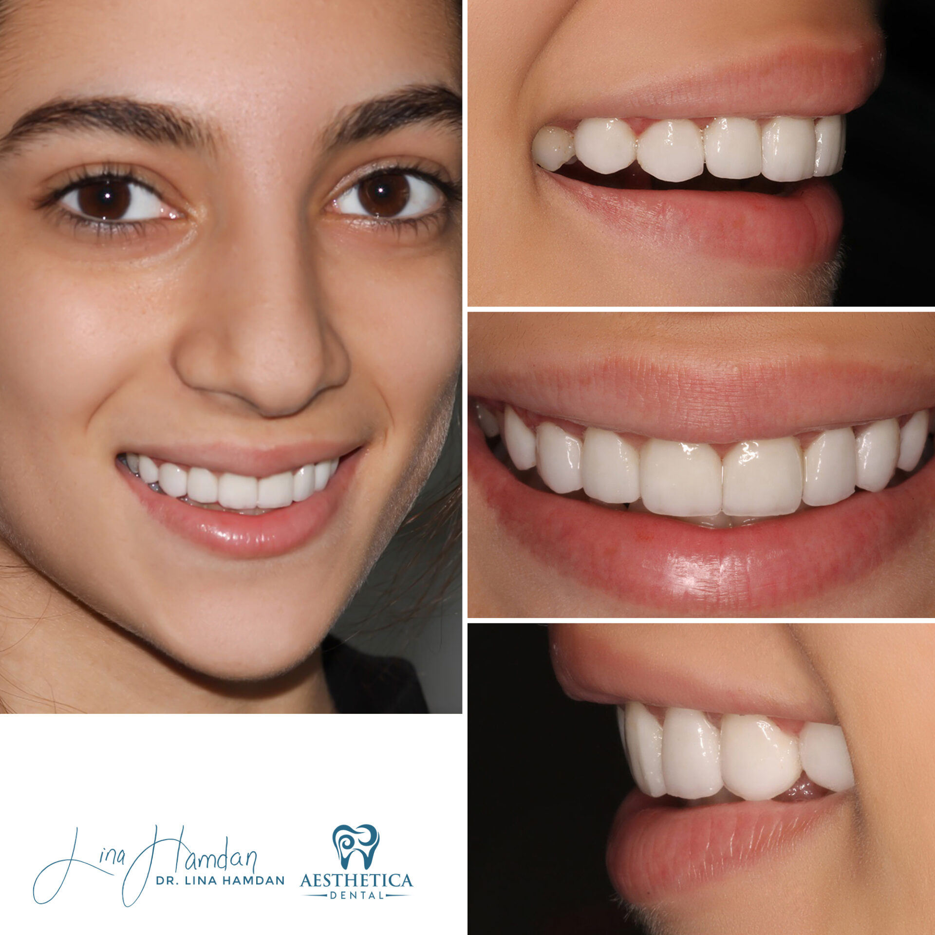 Porcelain Veneers case done by Dr. Lina Hamdan. - Before and After Images - 2