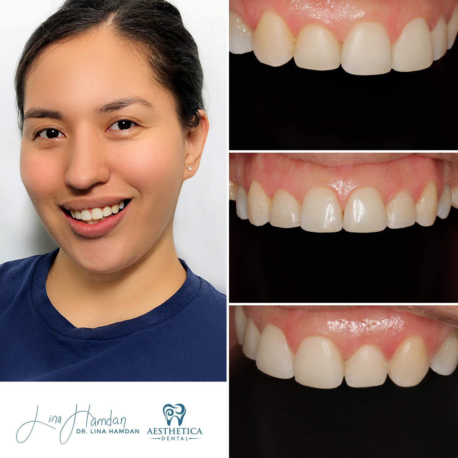 Dental Composite Bonding case 15 done by Dr. Lina Hamdan. - Before and After Images - 2