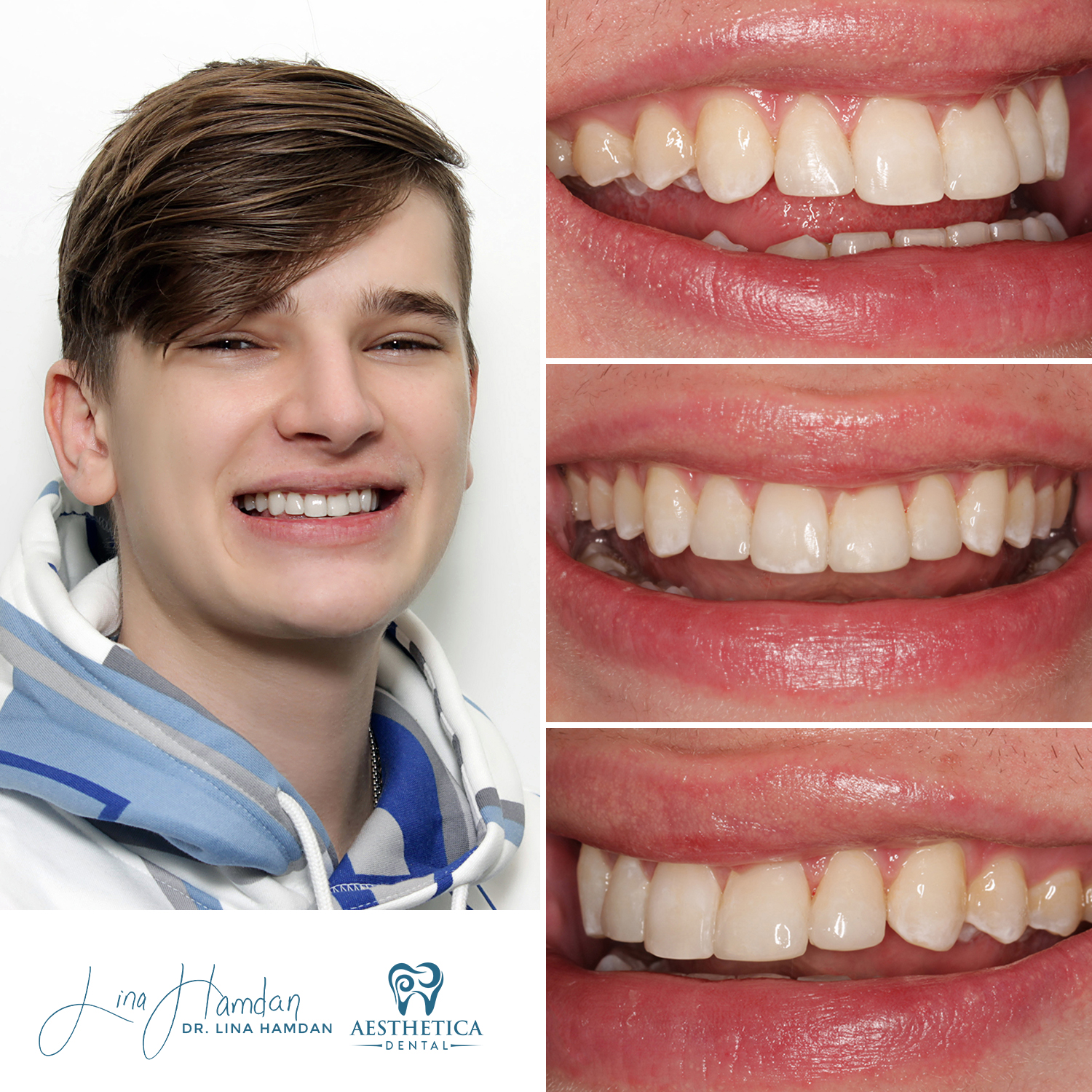 Dental Composite Bonding case 22 done by Dr. Lina Hamdan. - Before and After Images - 2